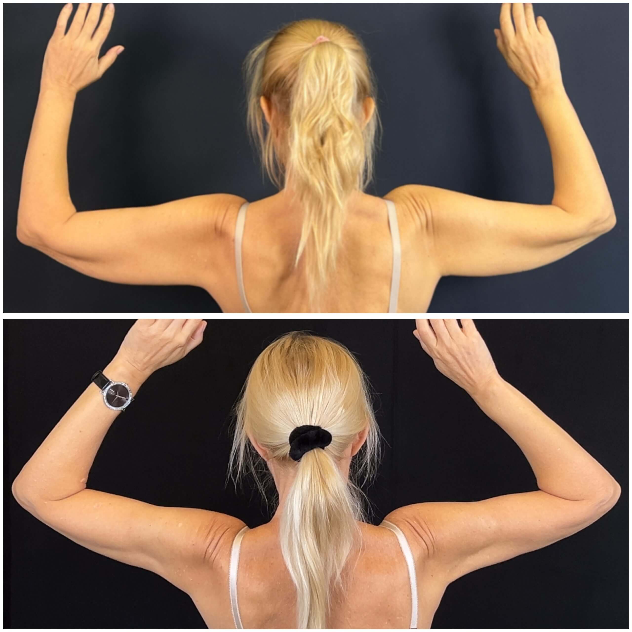 Липосакция рук 01