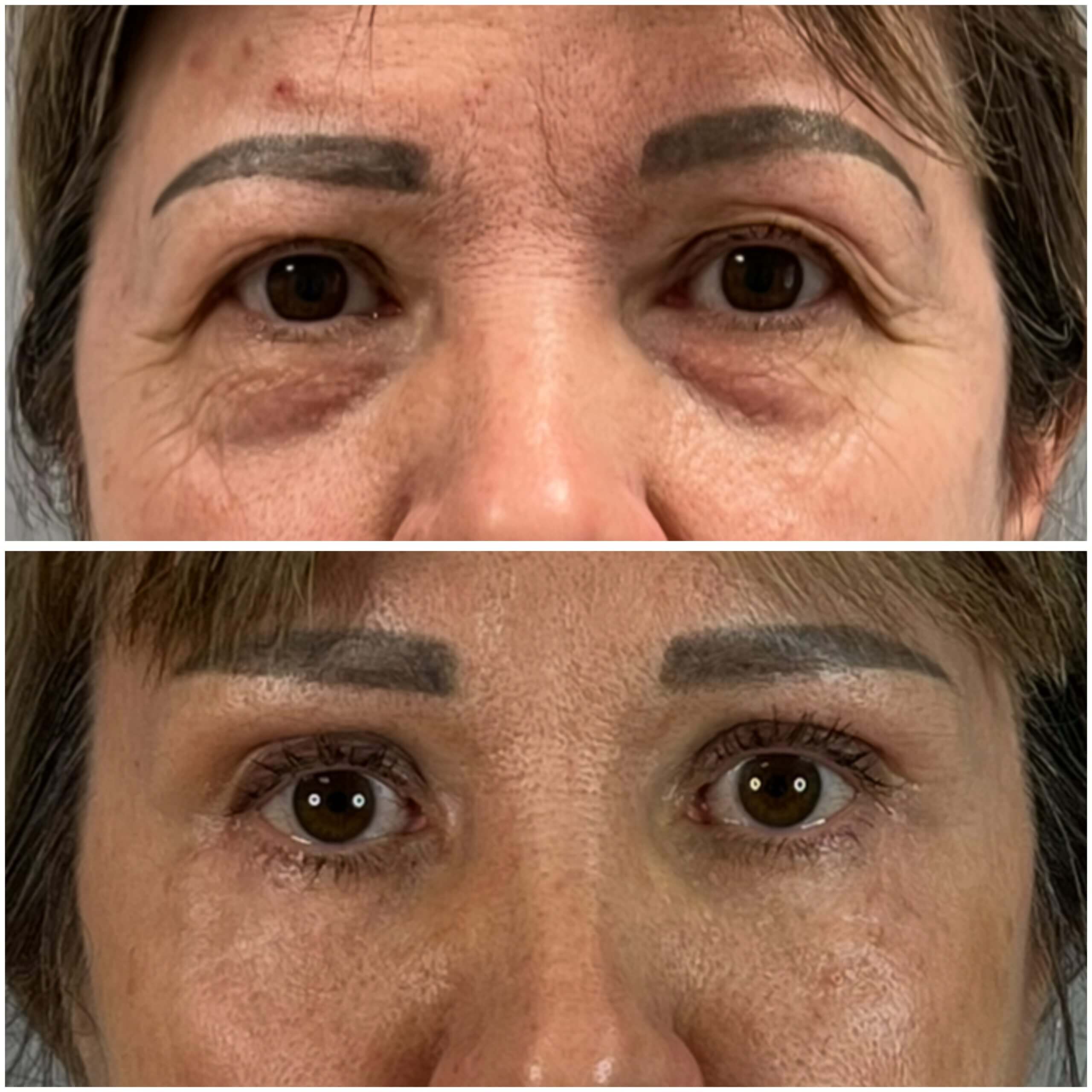 Нижняя блефаропластика 01