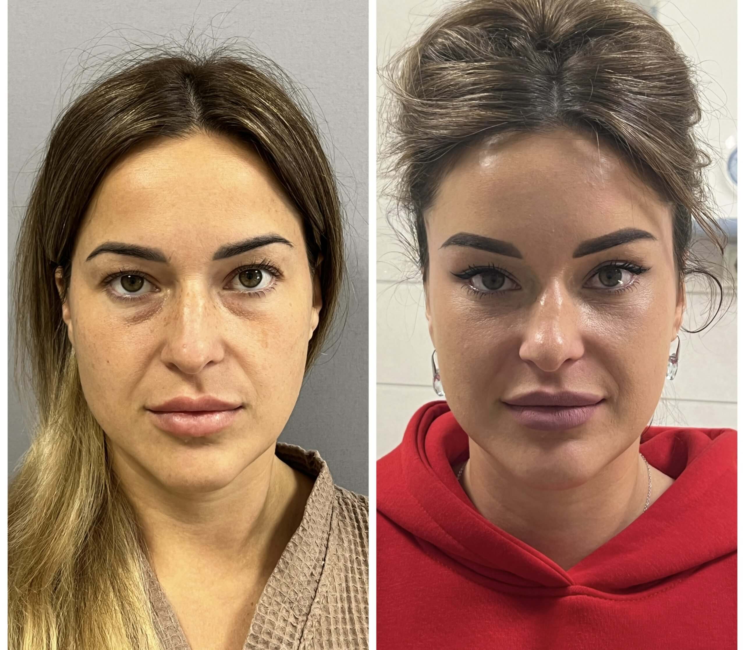 Нижняя блефаропластика 01