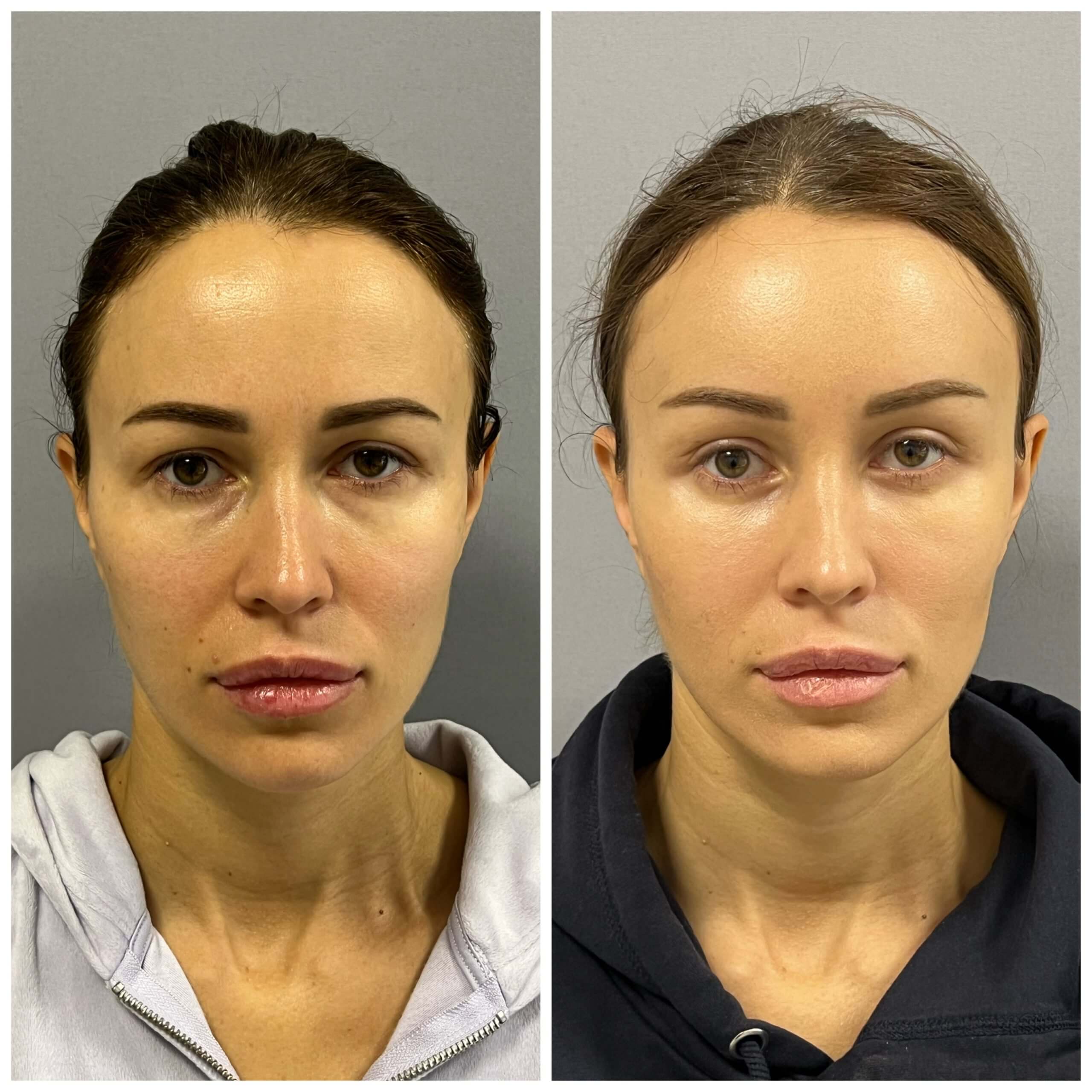 Нижняя блефаропластика 01