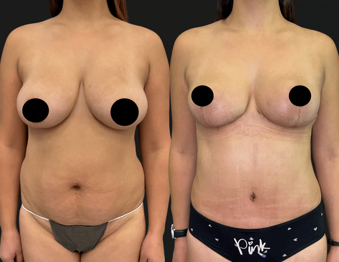 Подтяжка груди (мастопексия) 01