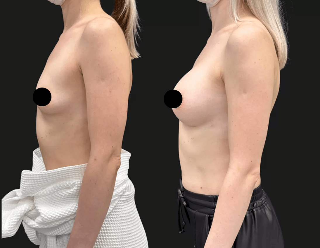 Увеличение груди имплантами 01