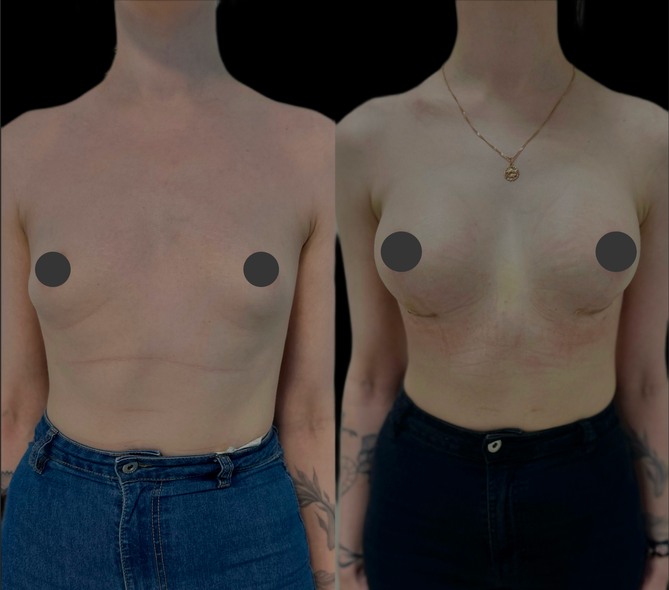 Увеличение груди имплантами 01