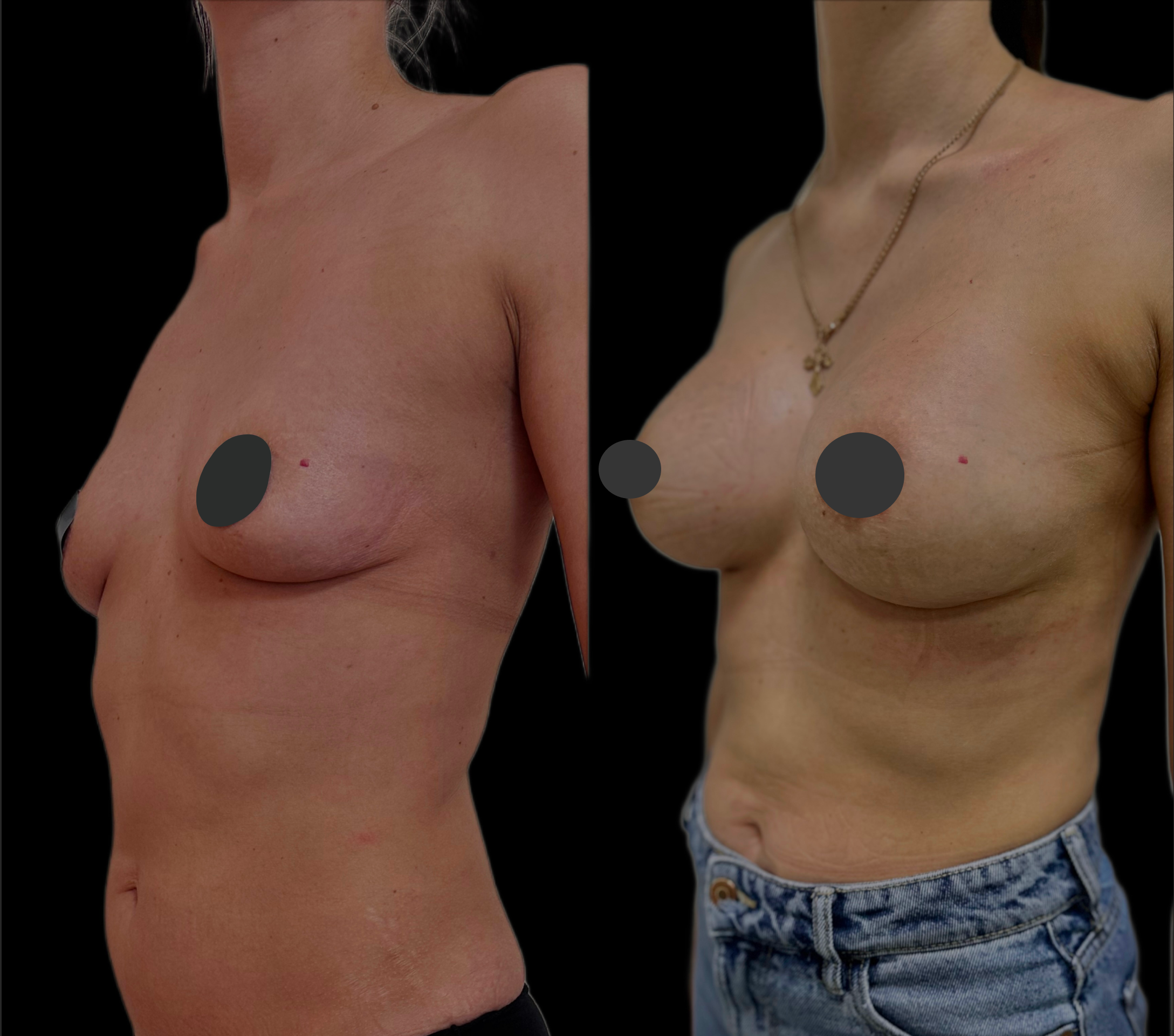 Увеличение груди имплантами 01