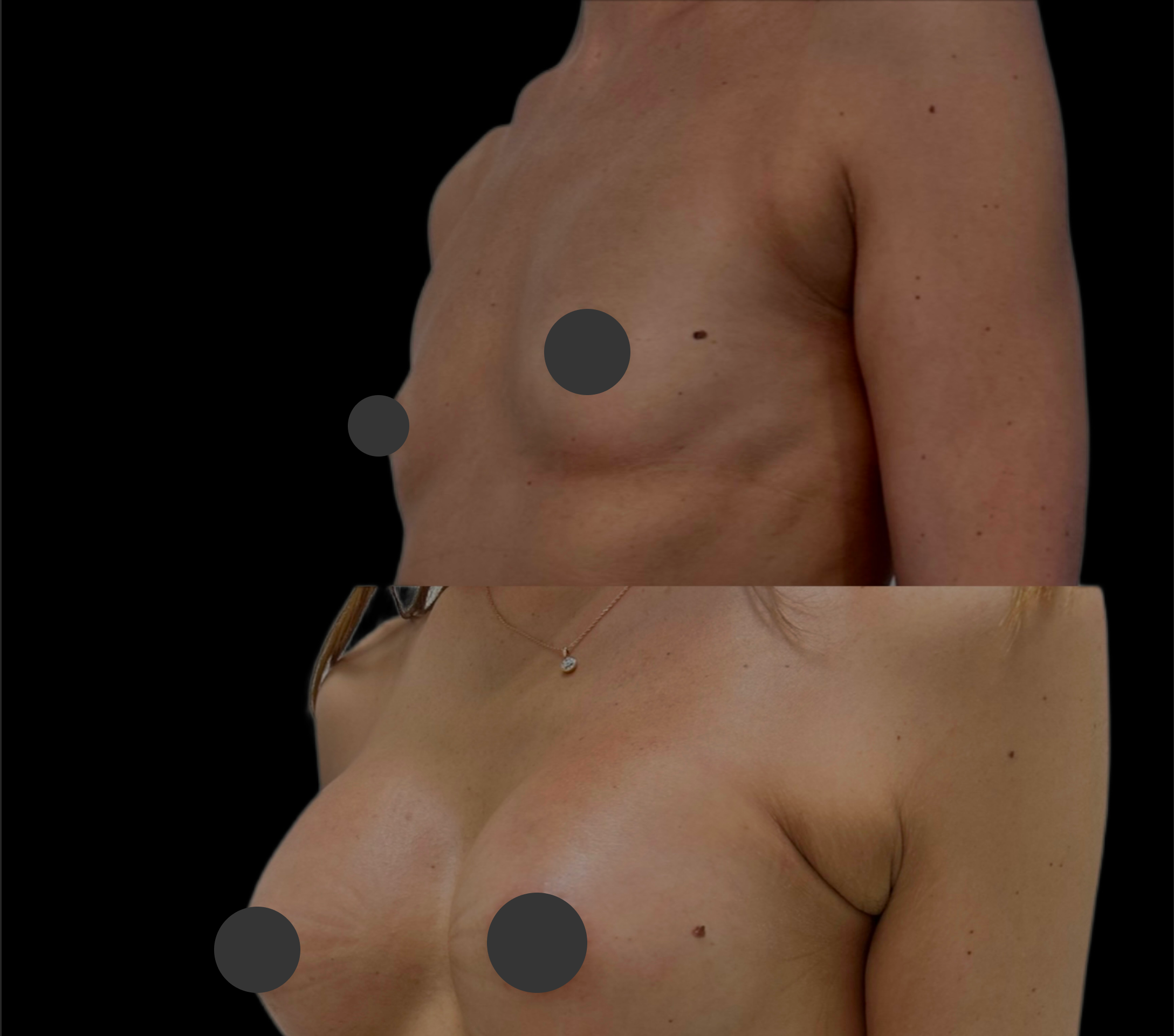 Увеличение груди имплантами 01