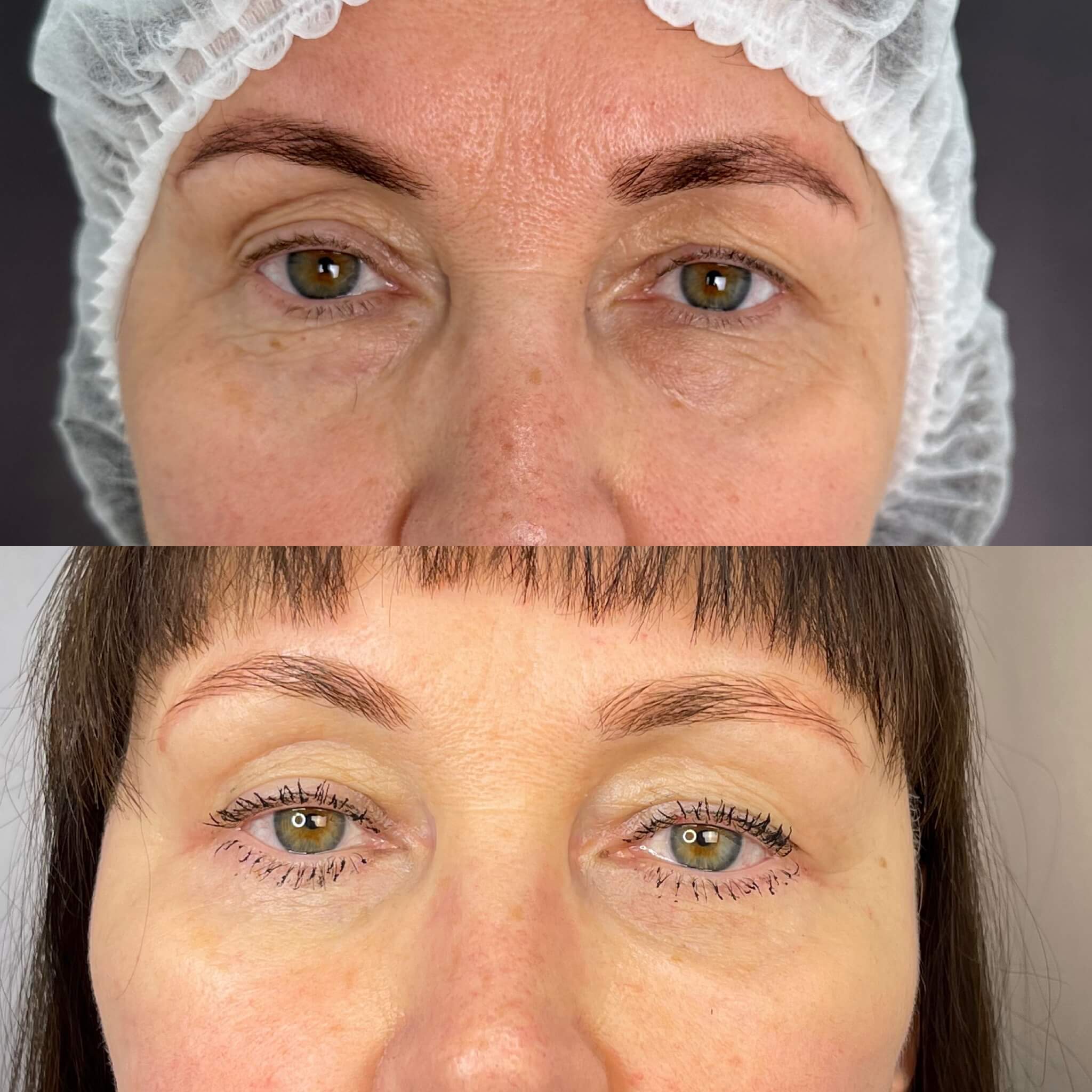 Нижняя блефаропластика 01