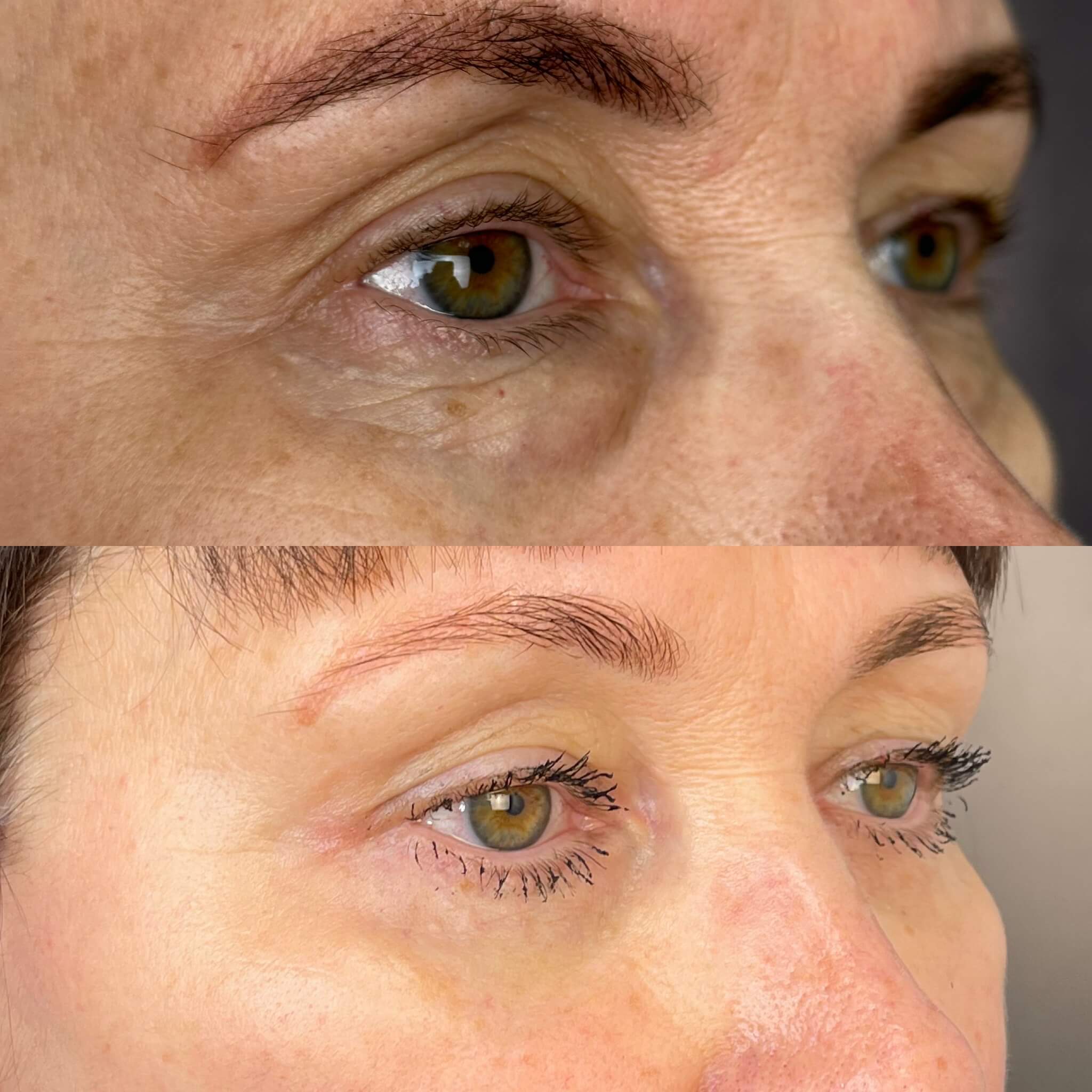 Нижняя блефаропластика 01