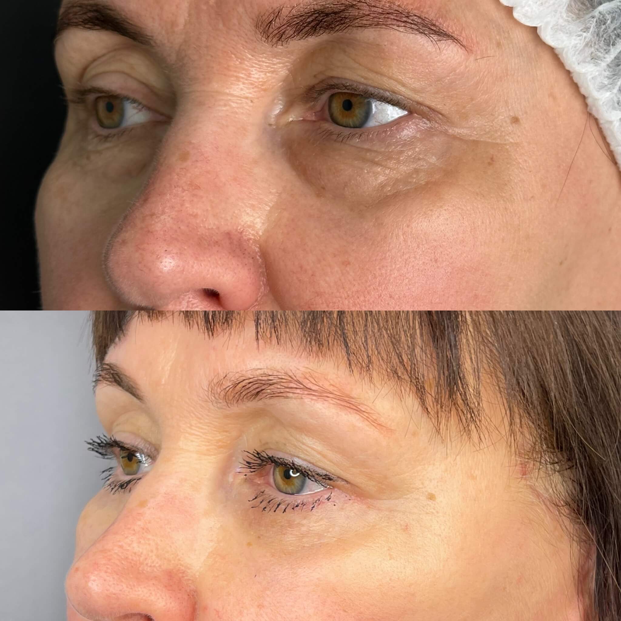 Нижняя блефаропластика 01