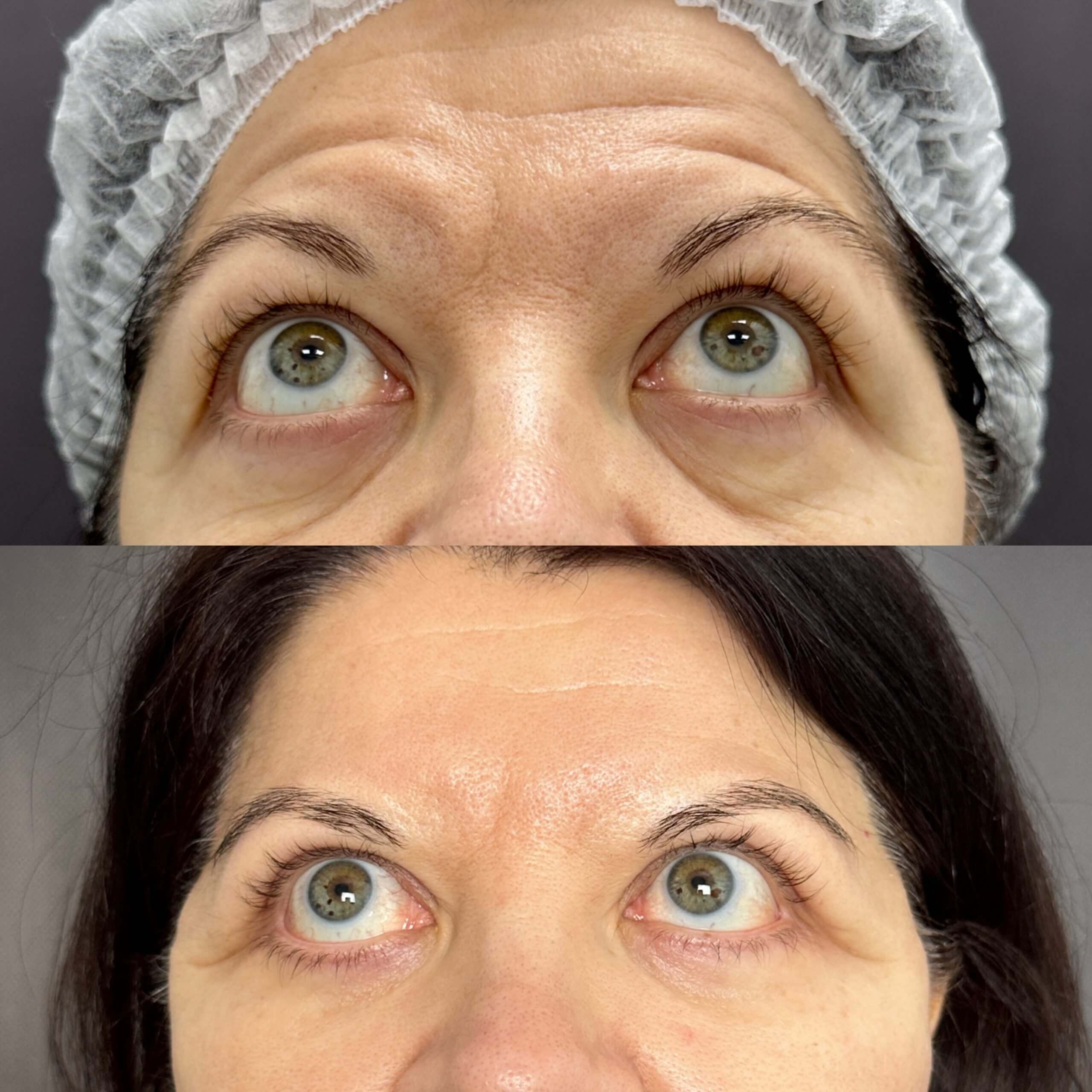 Нижняя блефаропластика 01