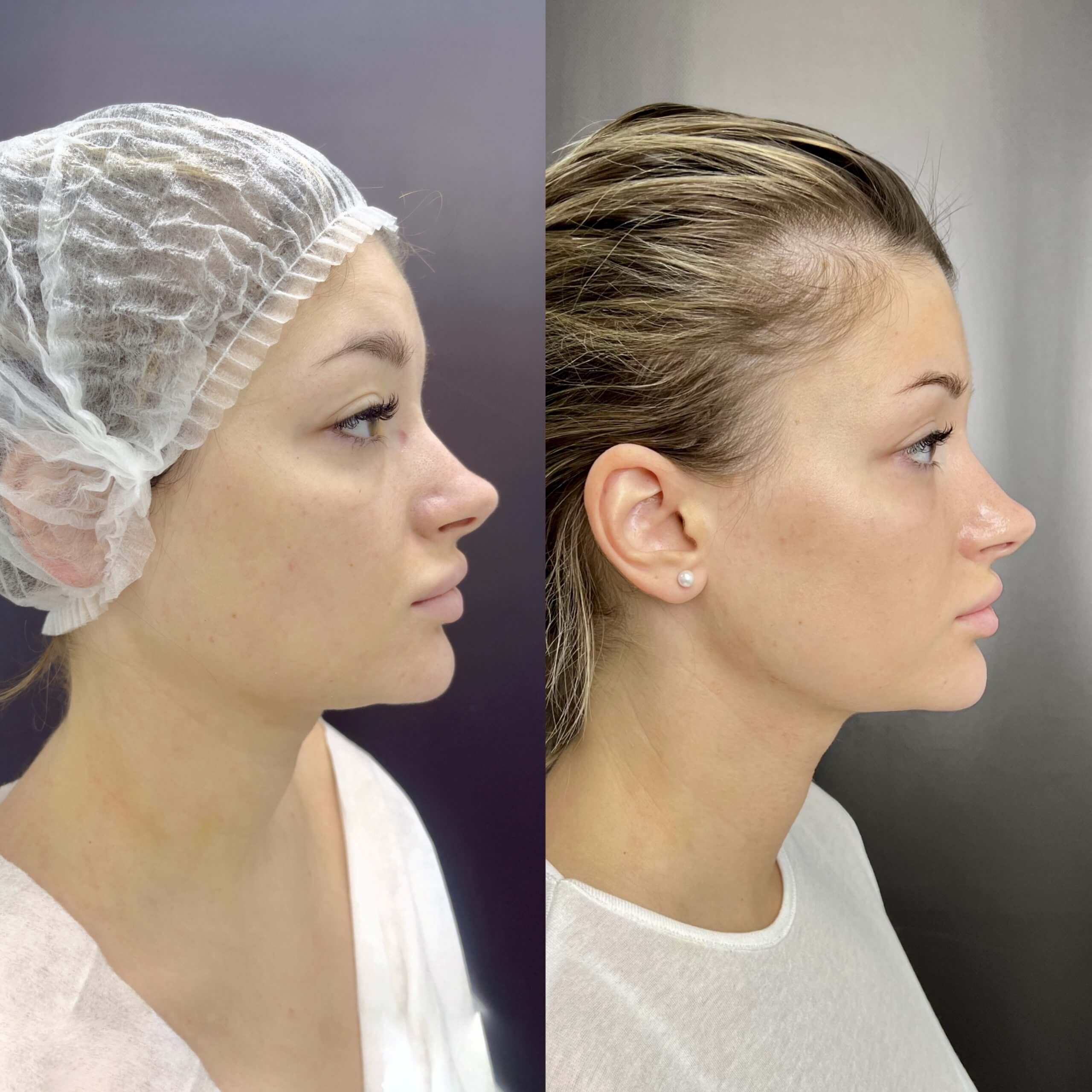 Липосакция подбородка и шеи 01