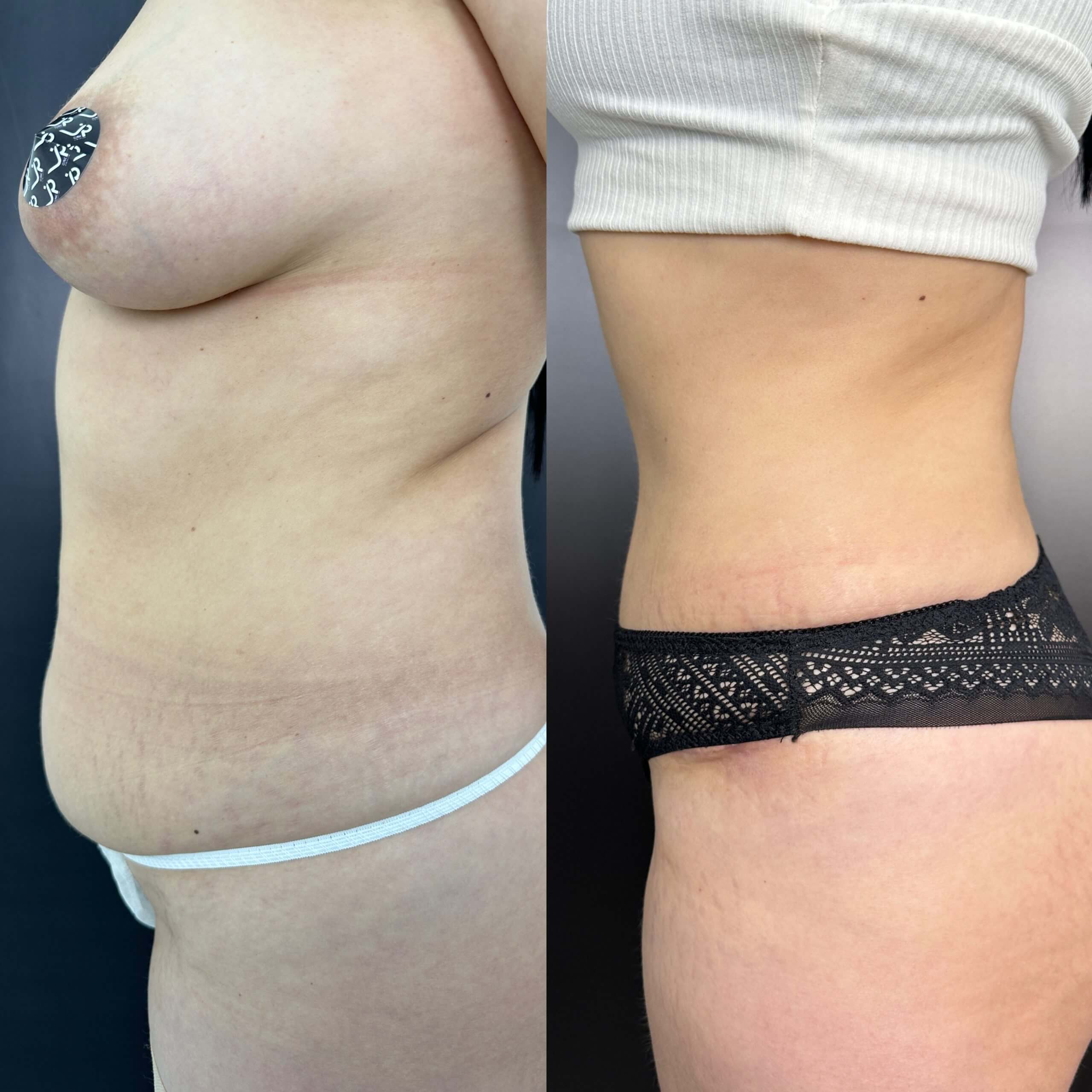 Ушивание диастаза 01