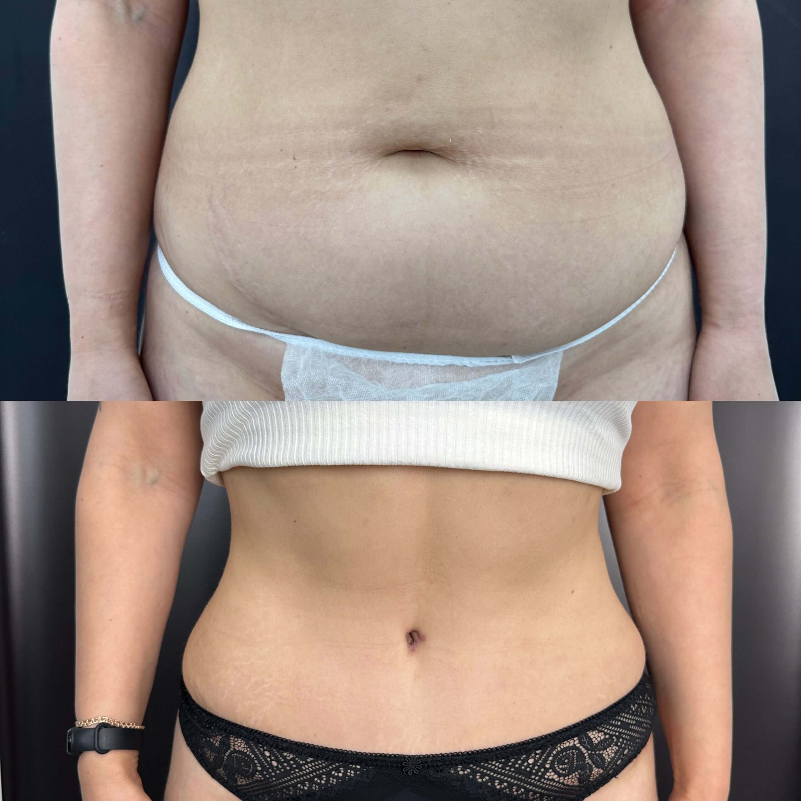 Ушивание диастаза 01