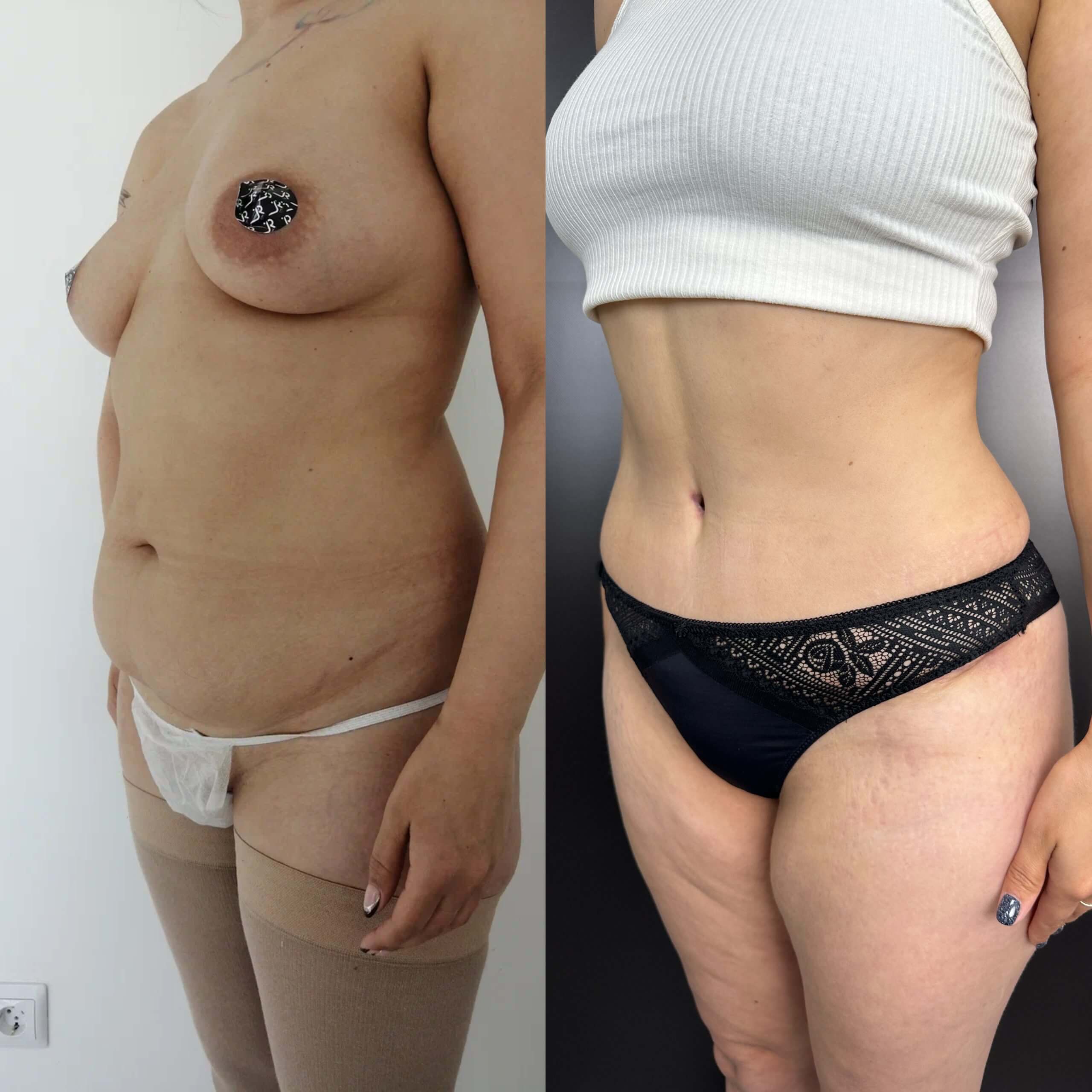 Ушивание диастаза 01