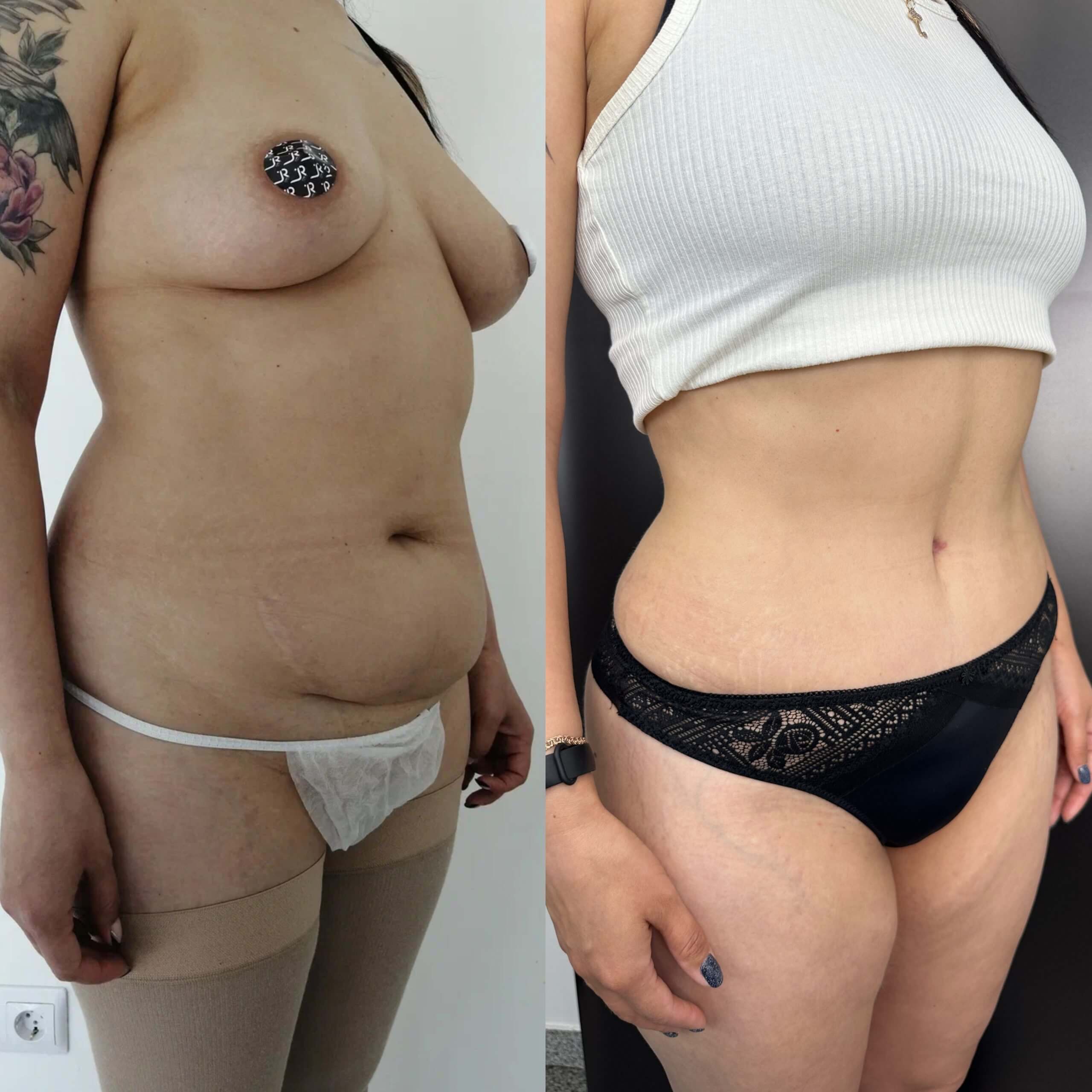 Ушивание диастаза 01