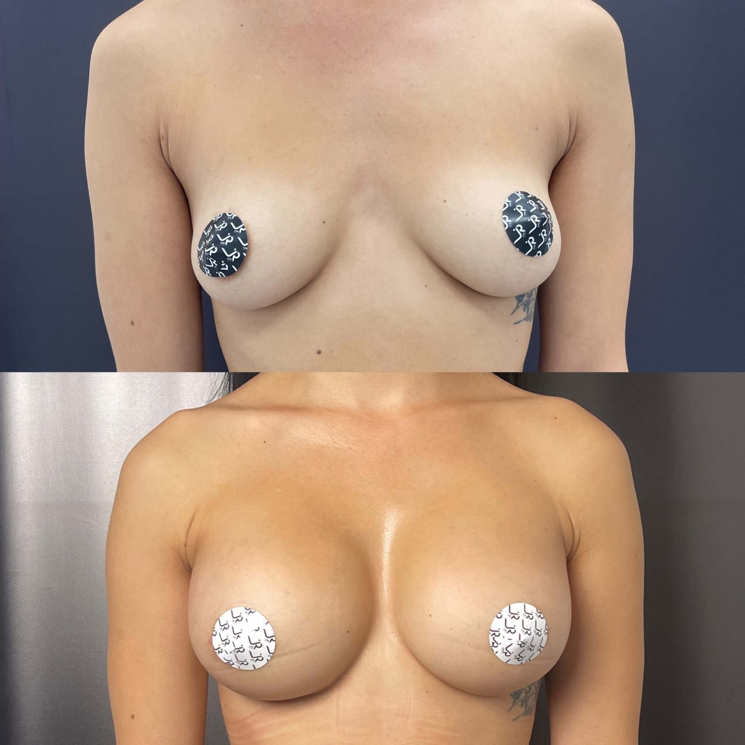Увеличение груди имплантами 01