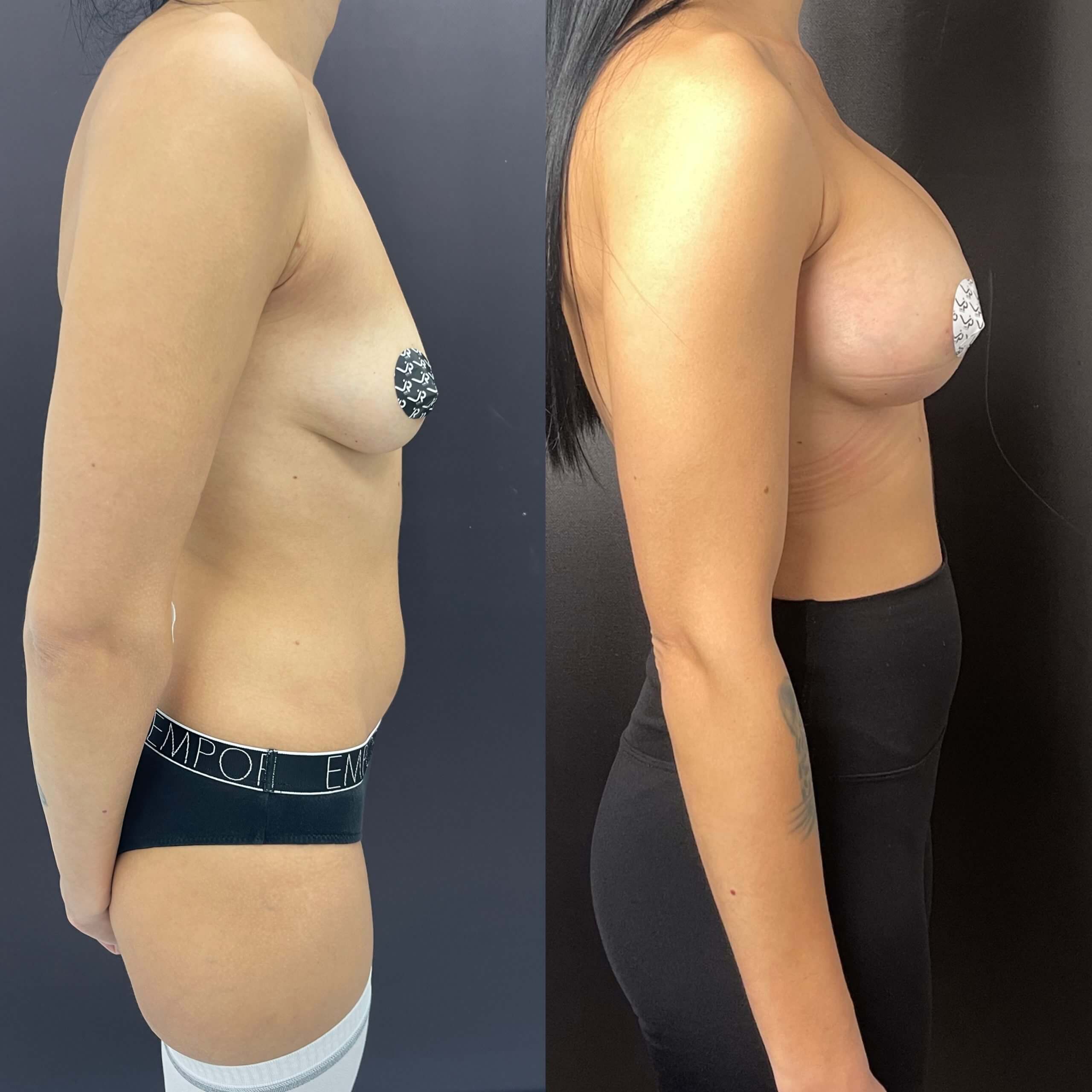 Увеличение груди имплантами 01