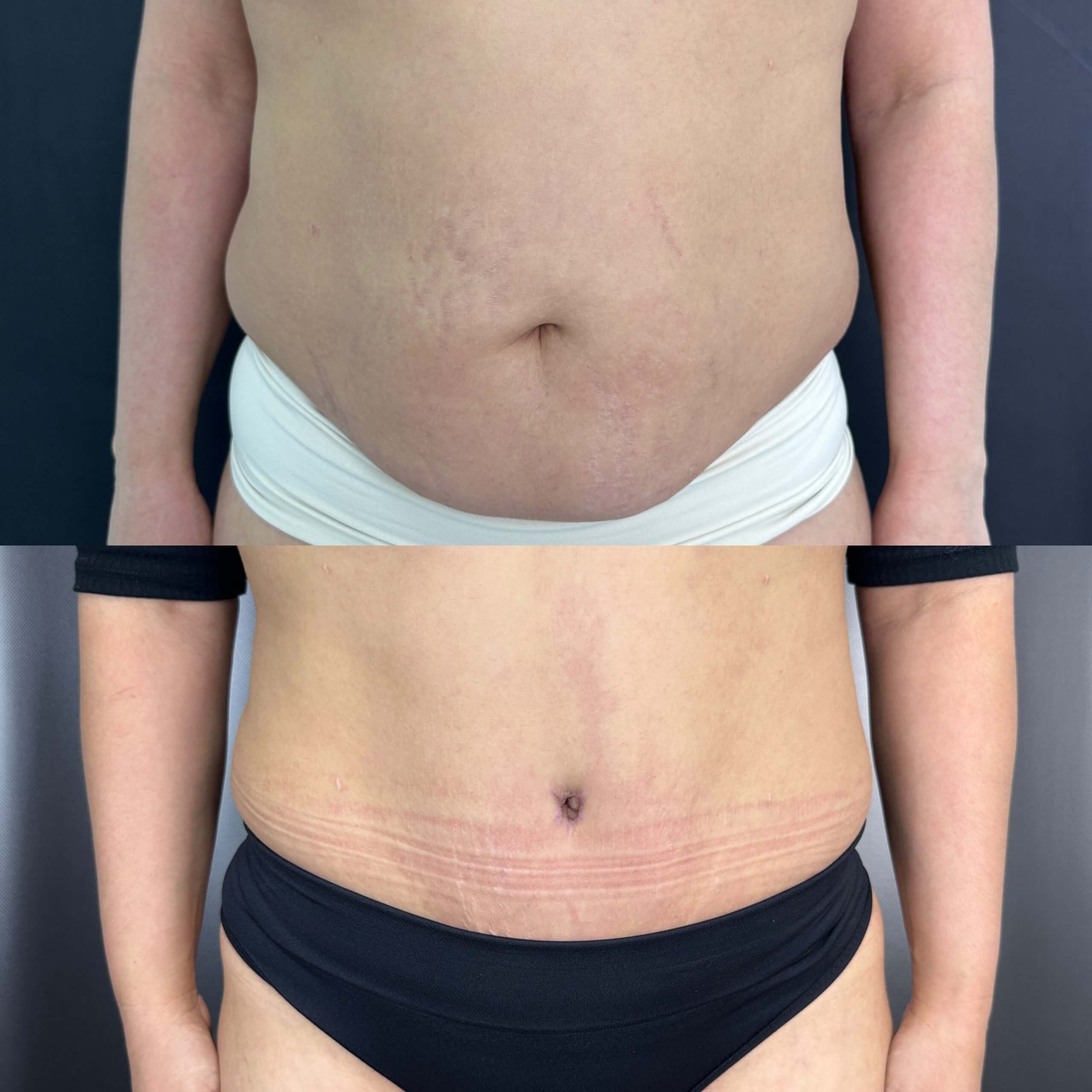 Ушивание диастаза 01