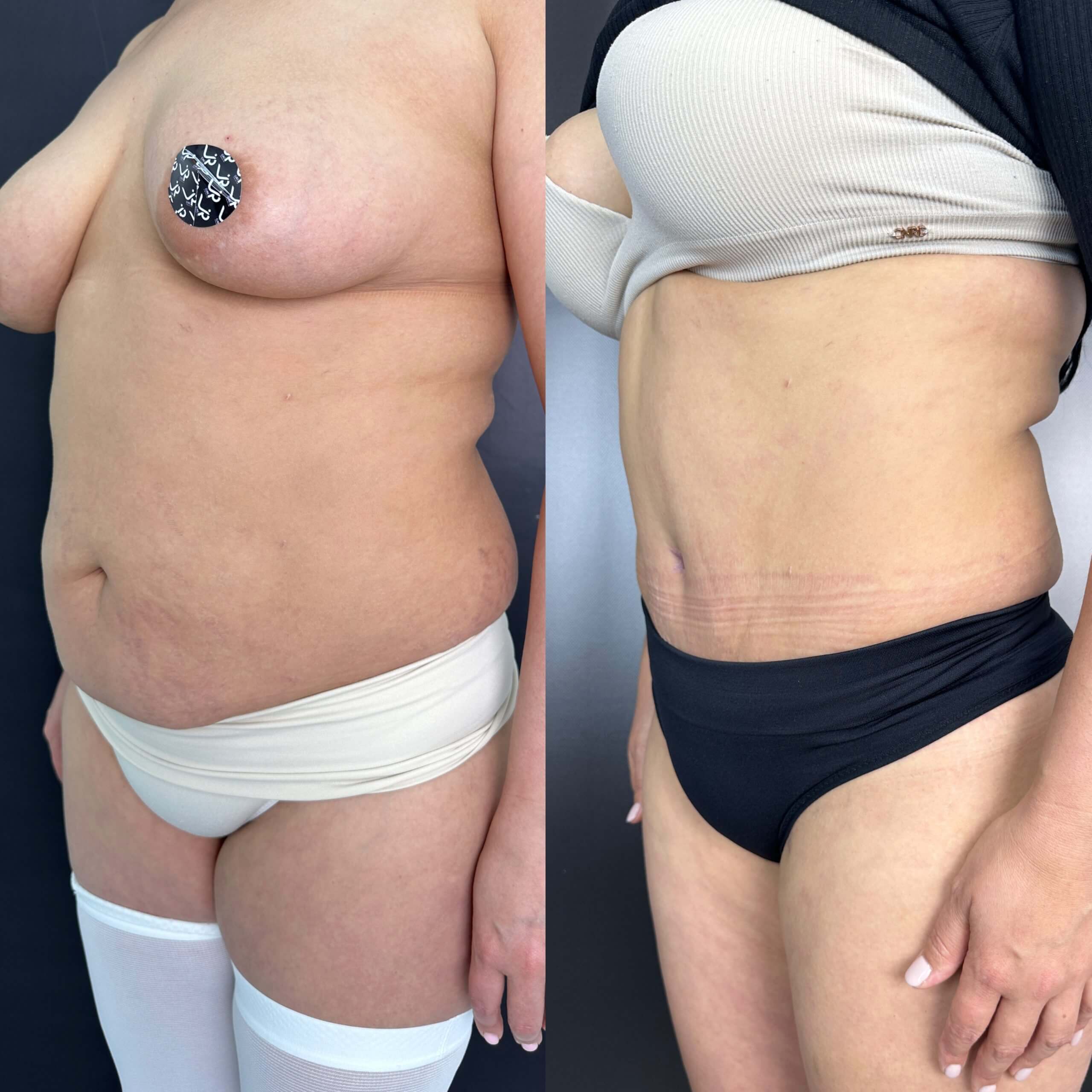 Ушивание диастаза 01