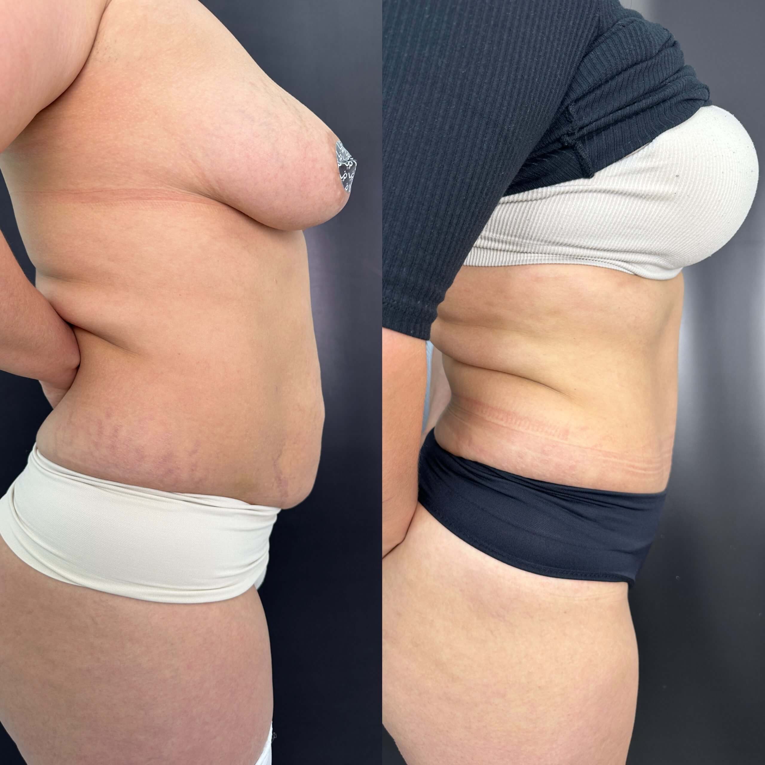 Ушивание диастаза 01