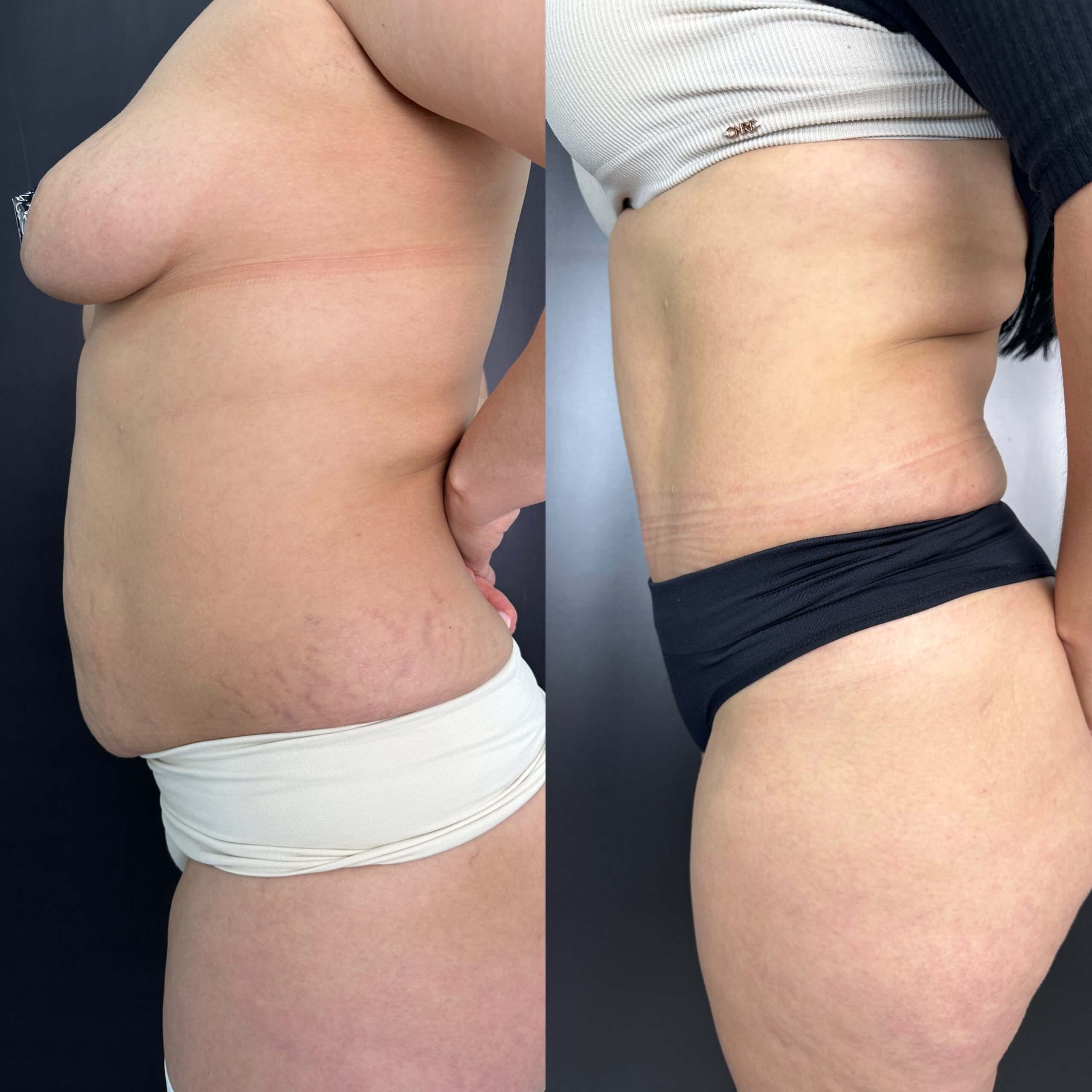 Ушивание диастаза 01