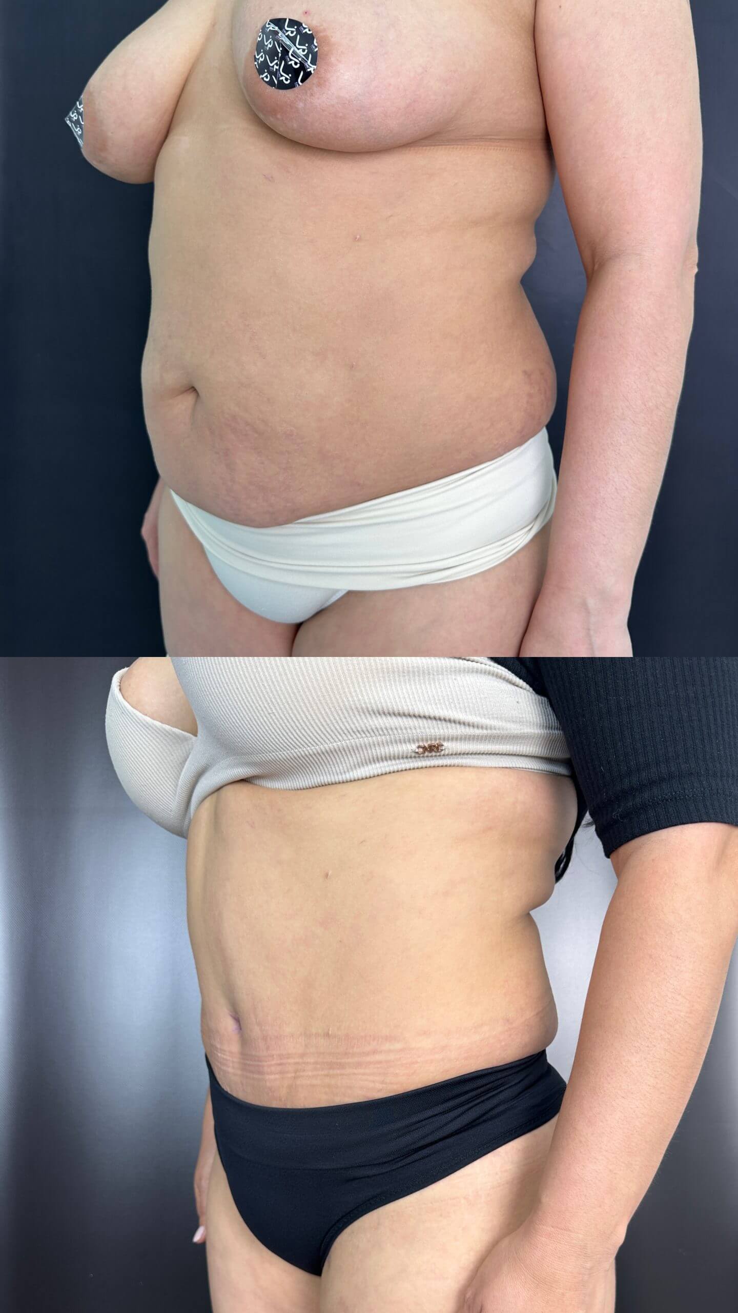 Ушивание диастаза 01