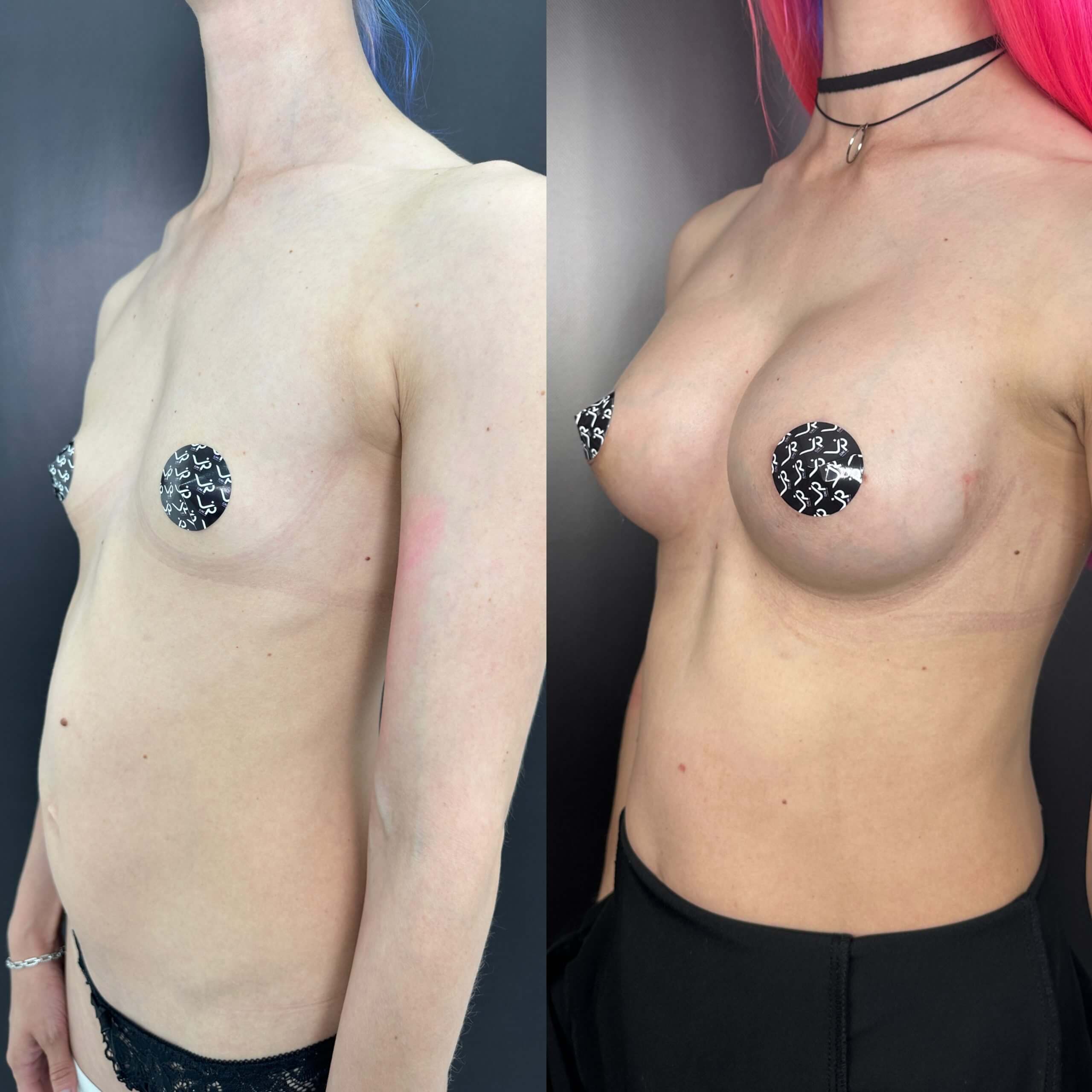 Увеличение груди имплантами 01