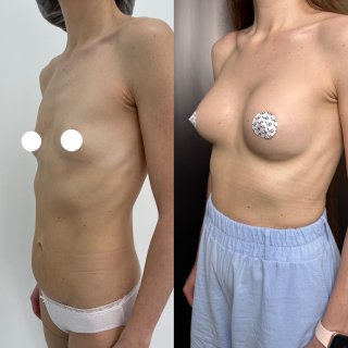 Увеличение груди имплантами 01