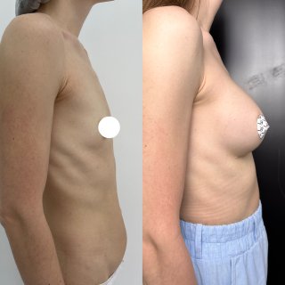 Увеличение груди имплантами 01