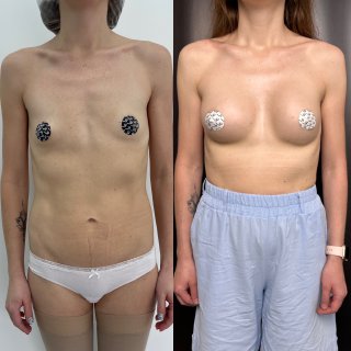 Увеличение груди имплантами 01