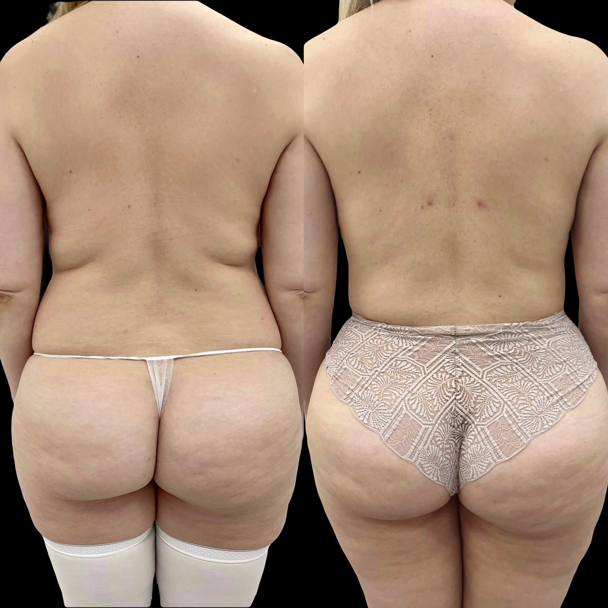 Липосакция спины 01