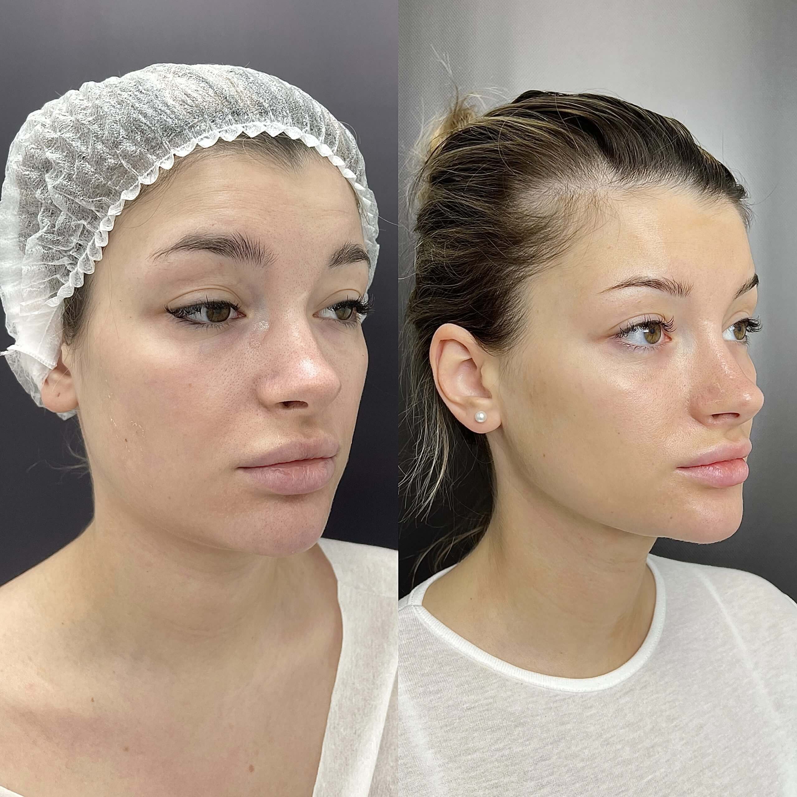 Липосакция подбородка и шеи 01