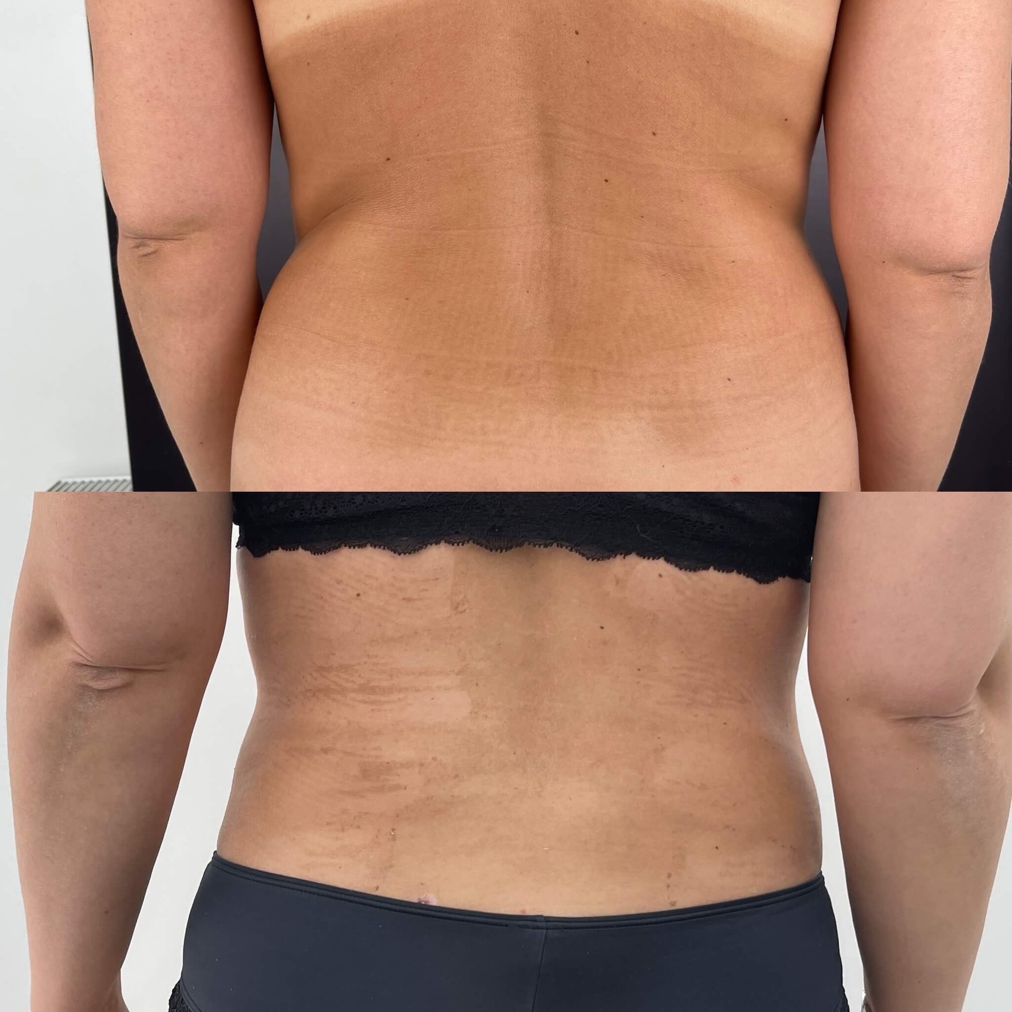 Липомоделирование тела 01