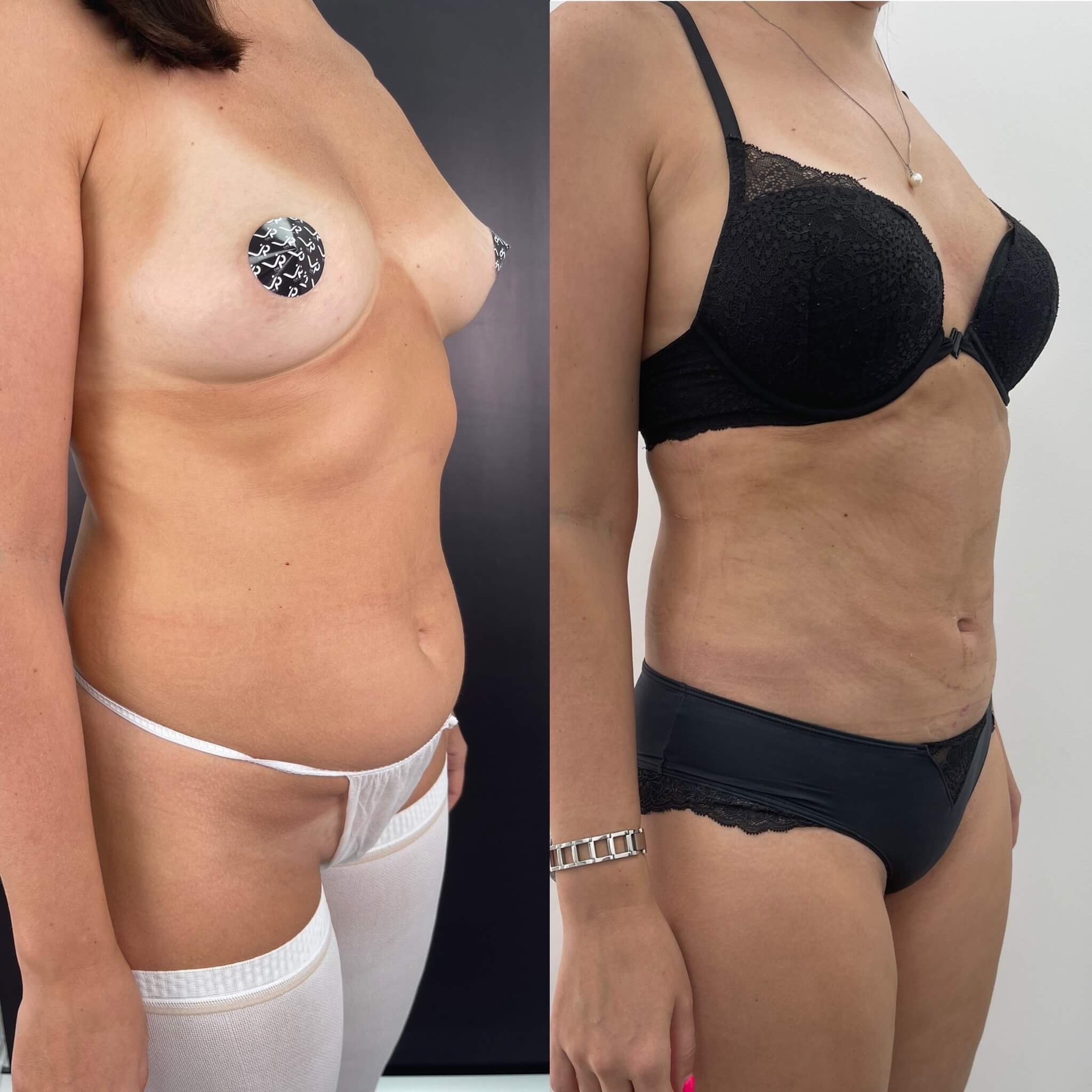 Липомоделирование тела 01