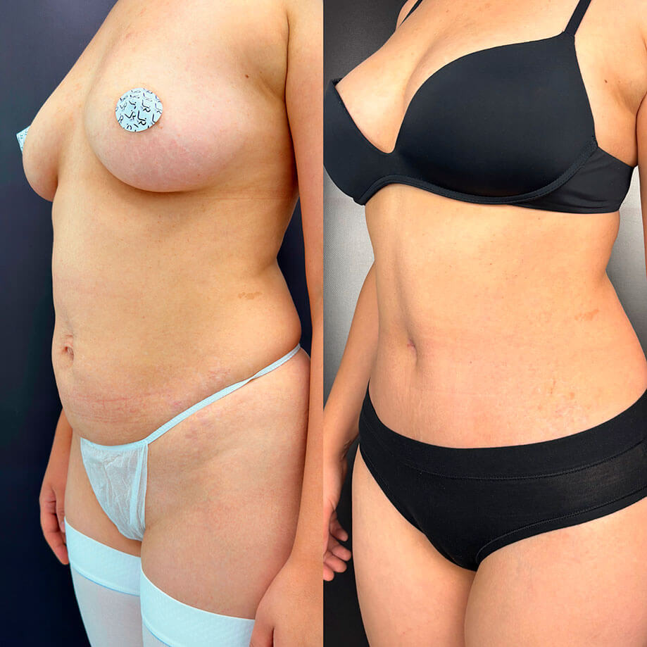 Абдоминопластика с переносом пупка 01