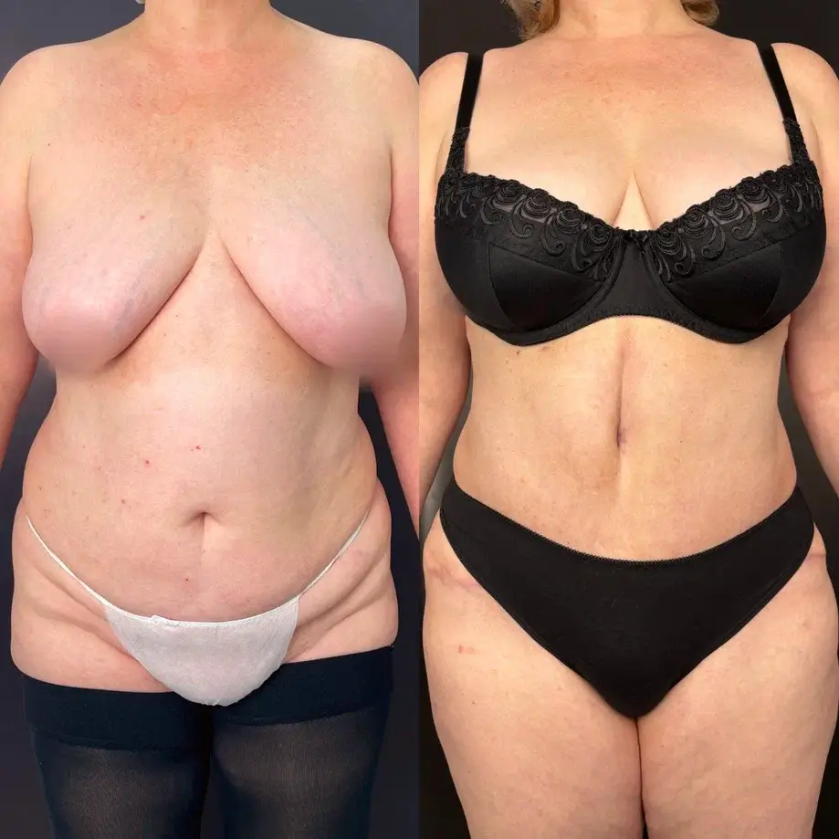 Абдоминопластика с переносом пупка 01