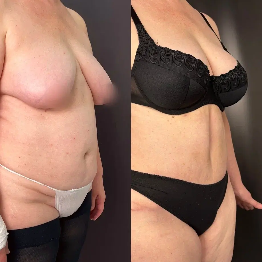 Абдоминопластика с переносом пупка 01