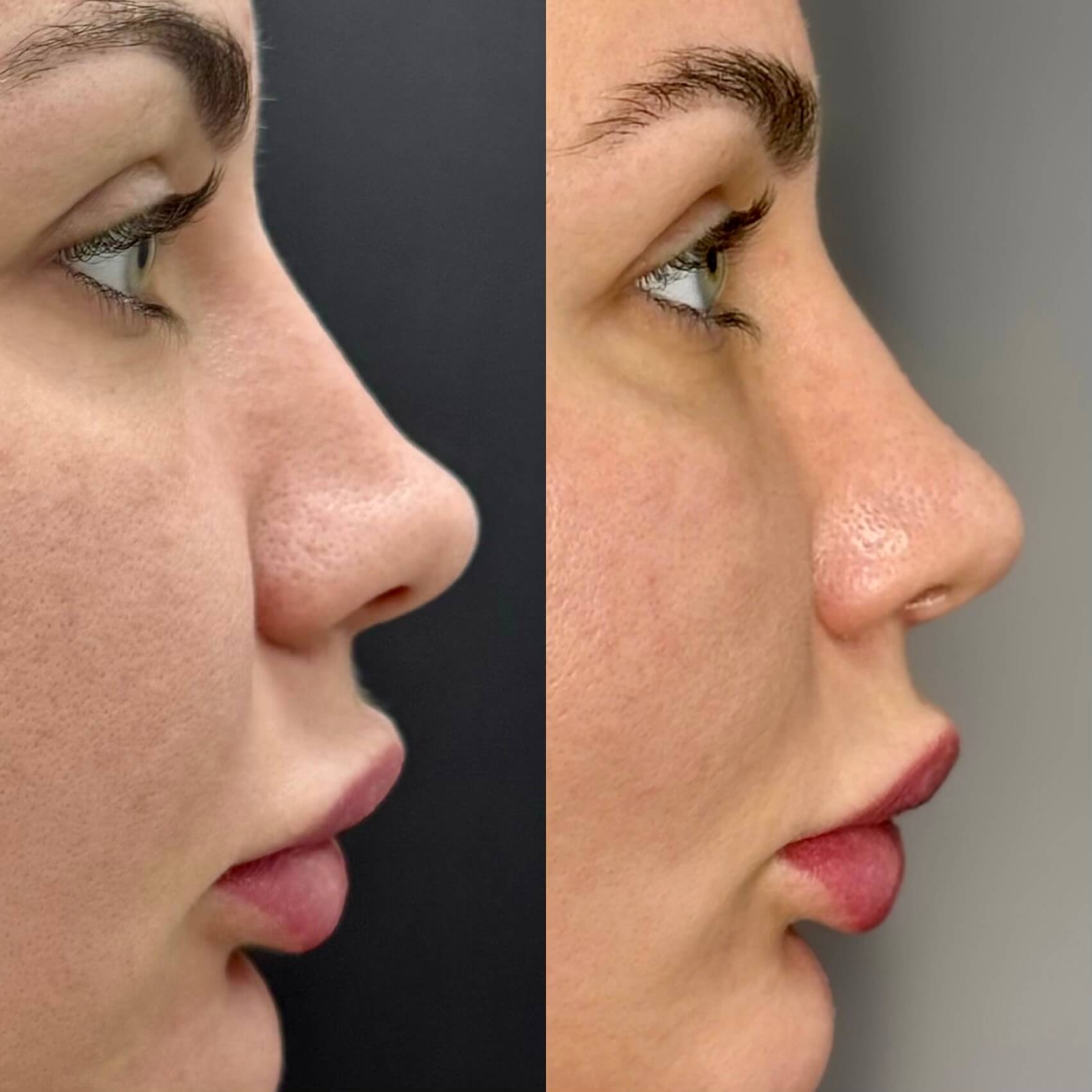 Ринопластика 01