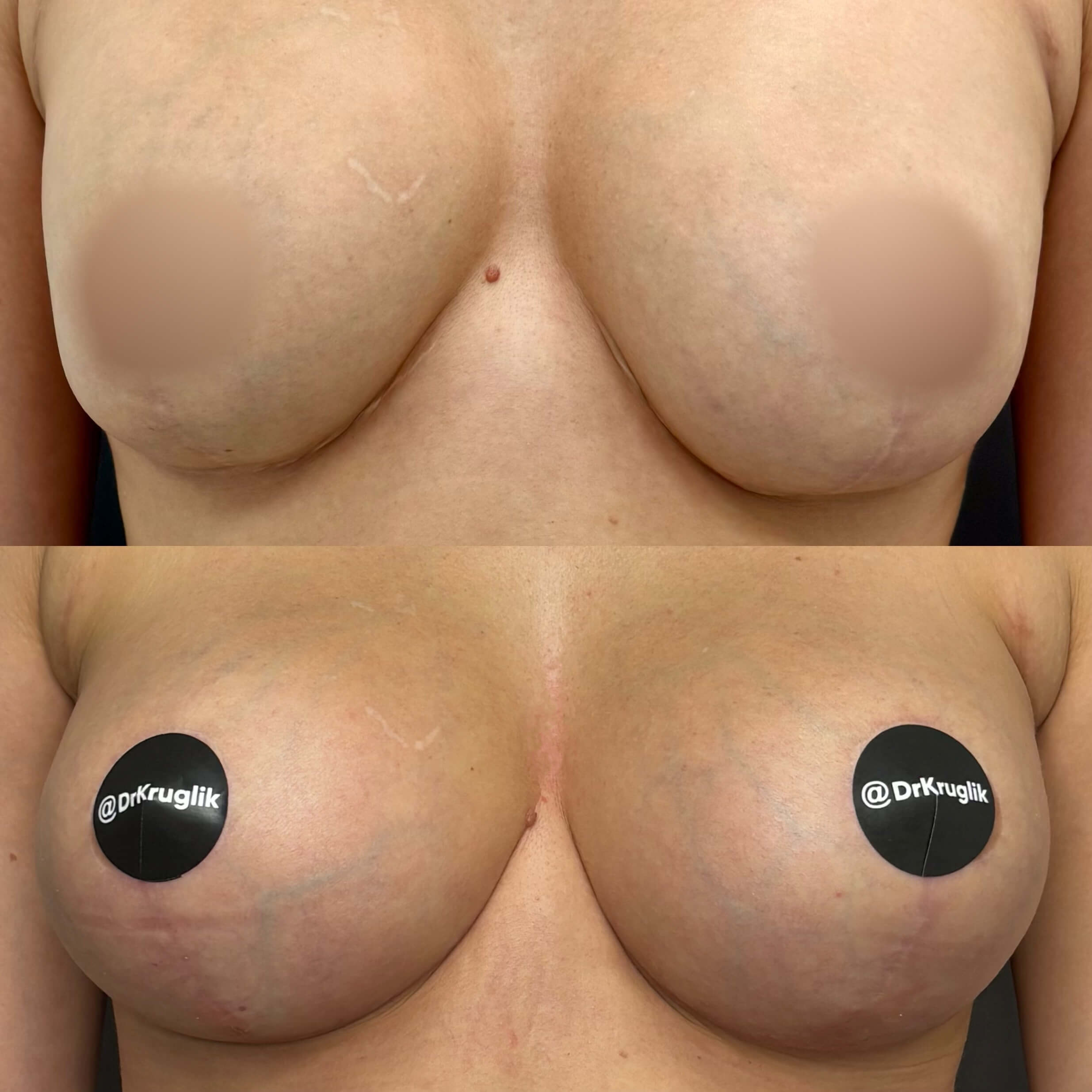 Увеличение груди имплантами 01