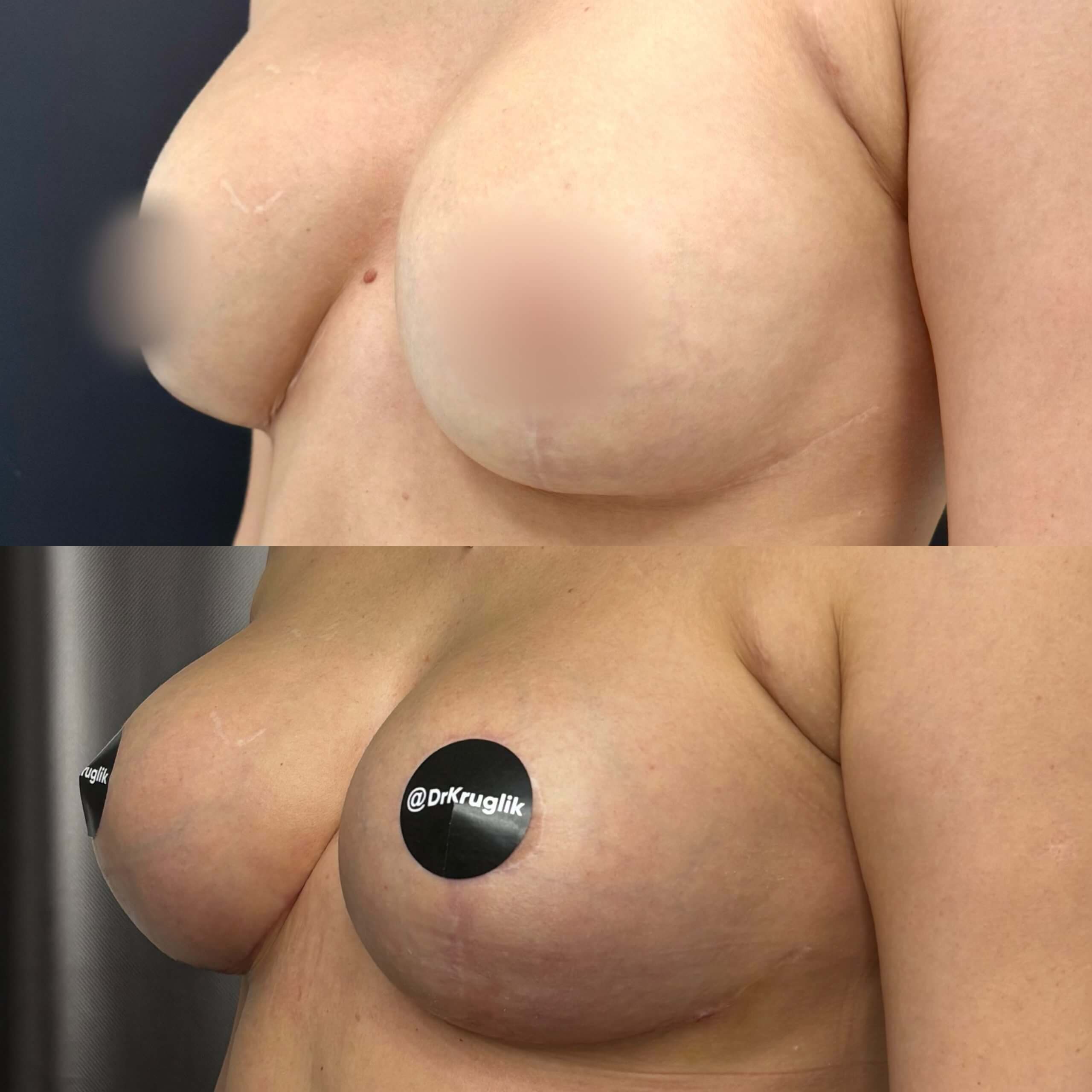 Увеличение груди имплантами 01