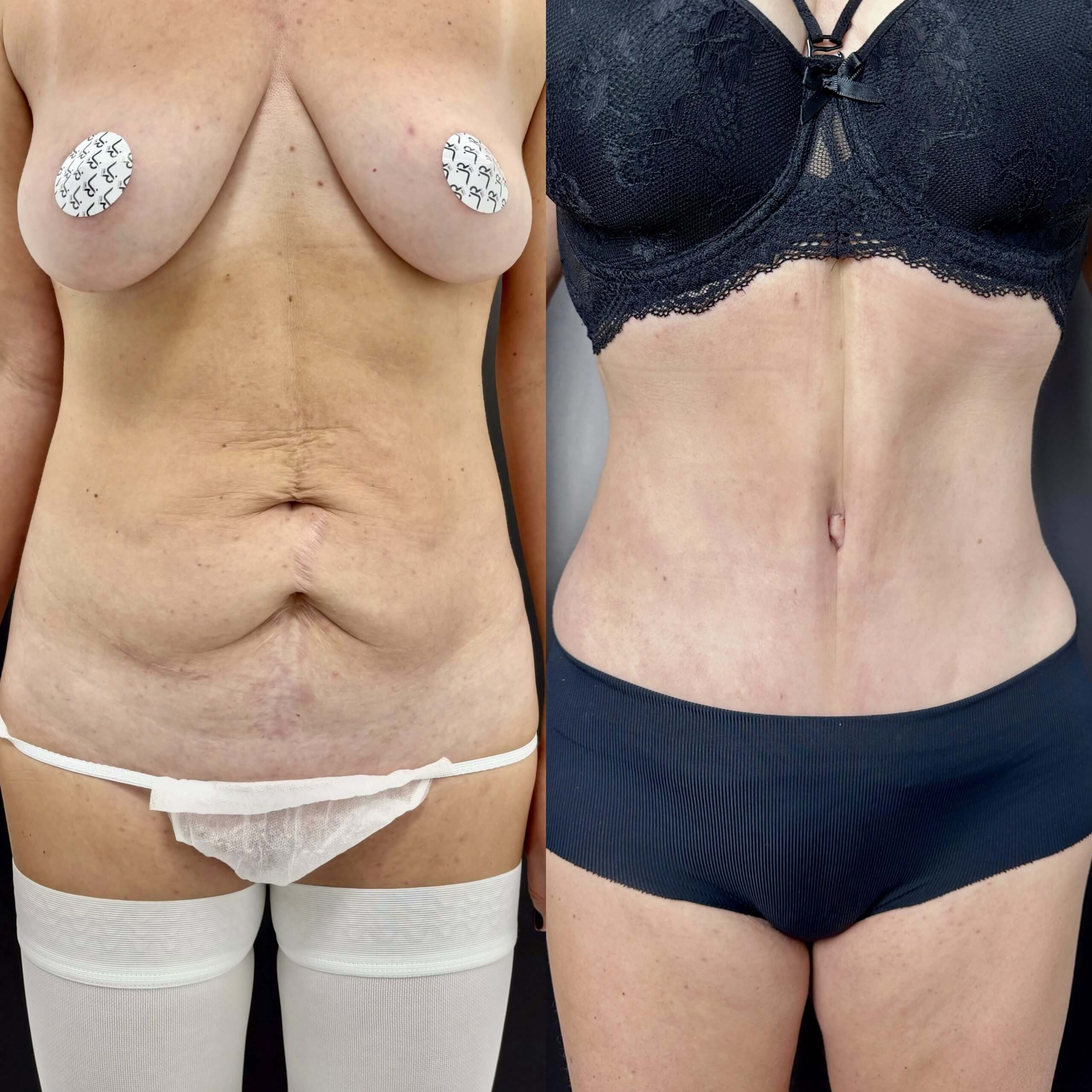 Ушивание диастаза 01