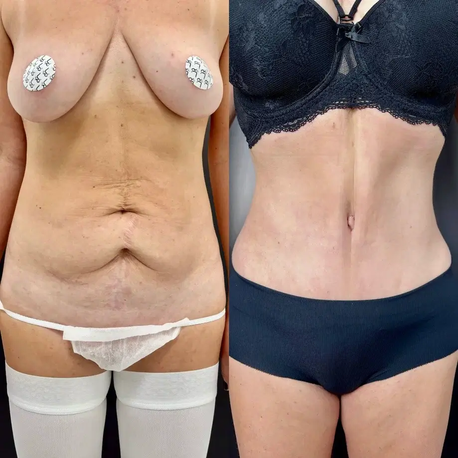 Абдоминопластика с переносом пупка 01