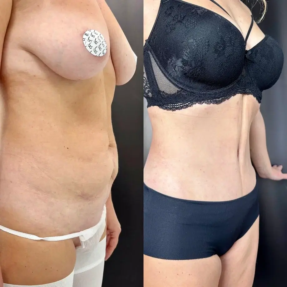 Абдоминопластика с переносом пупка 01