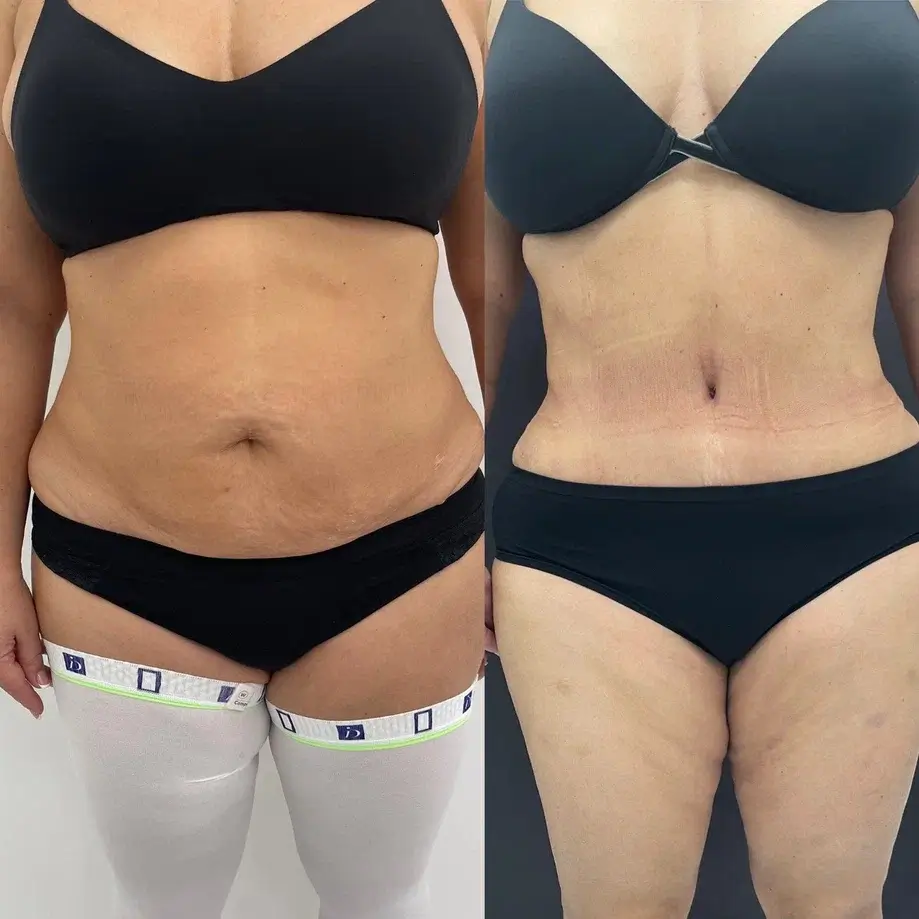 Абдоминопластика с переносом пупка 01