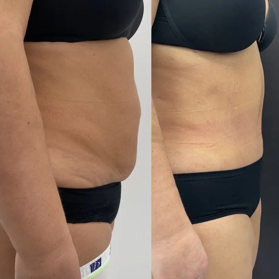 Абдоминопластика с переносом пупка 01