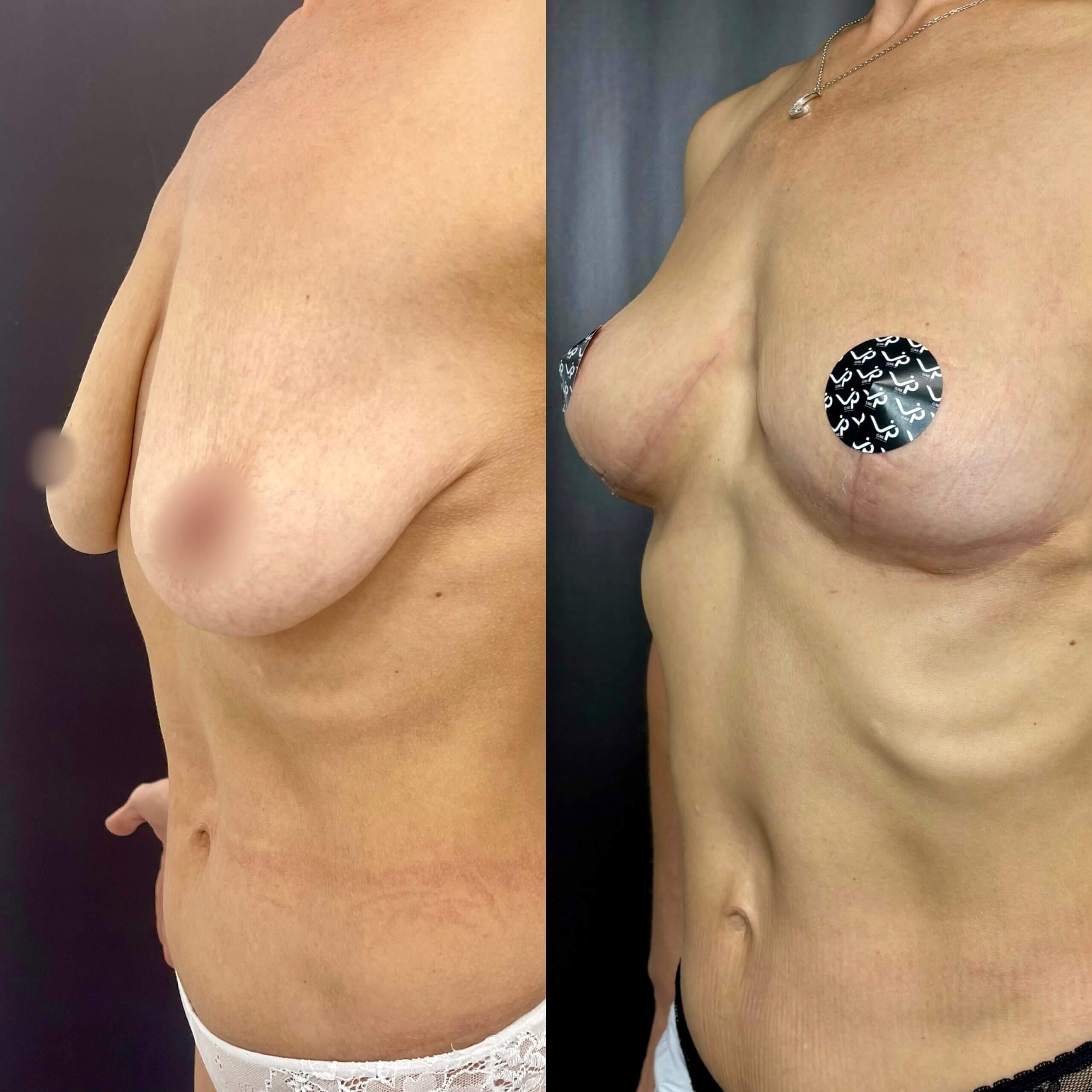 Подтяжка груди (мастопексия) 01