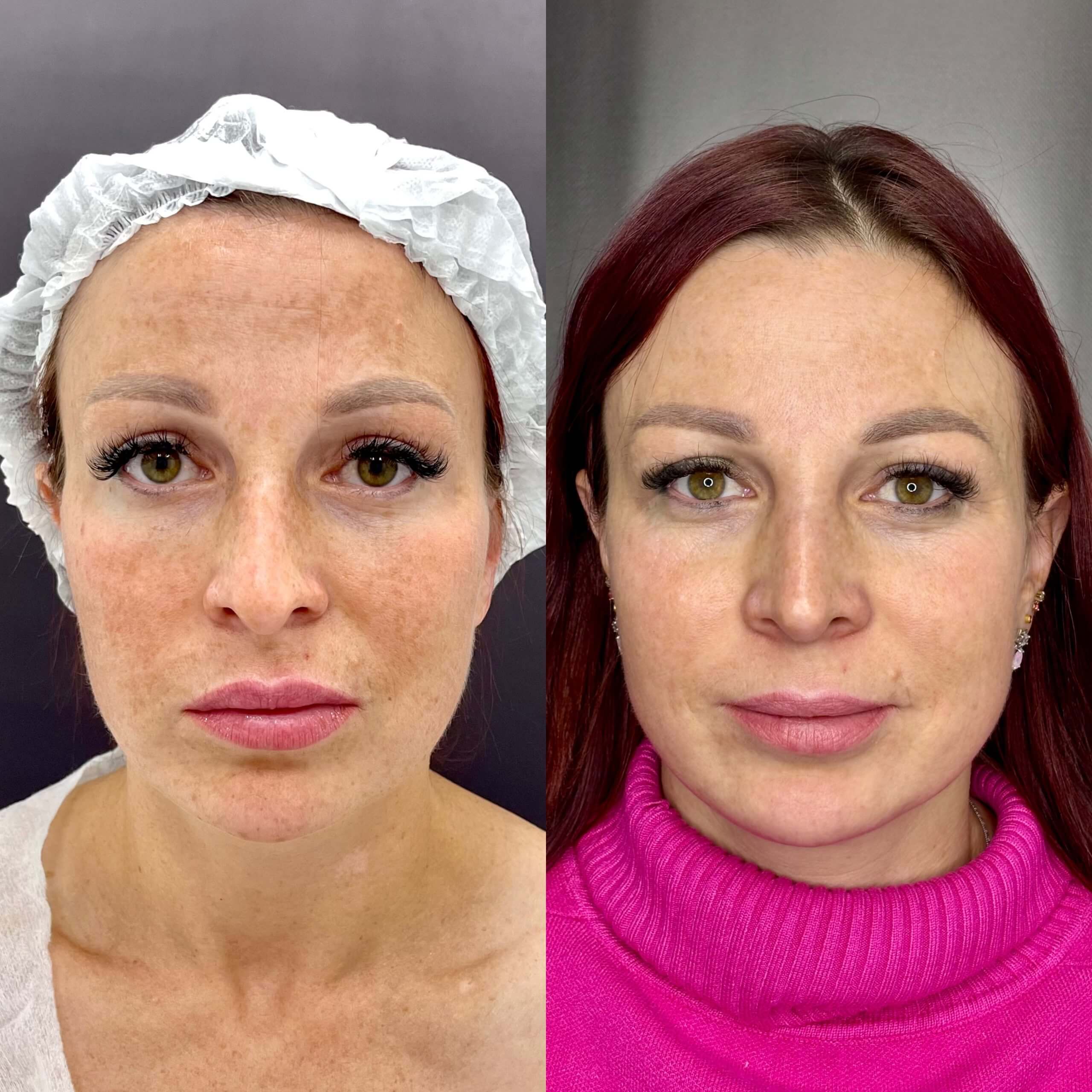 Ринопластика 01