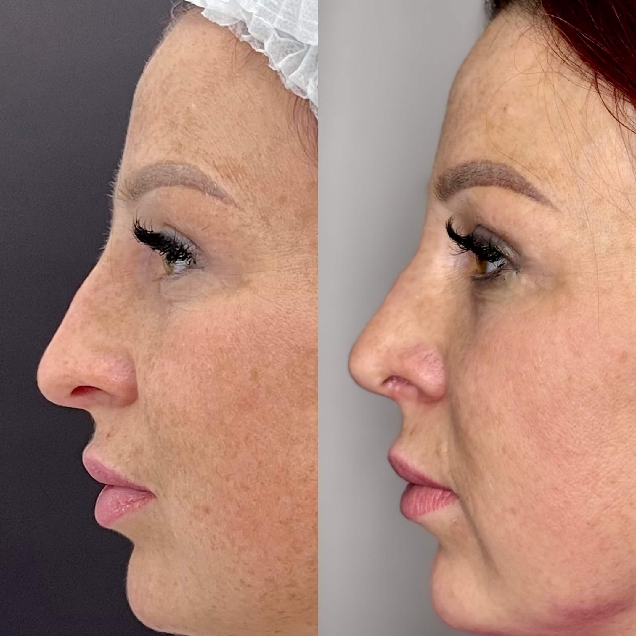 Ринопластика 01