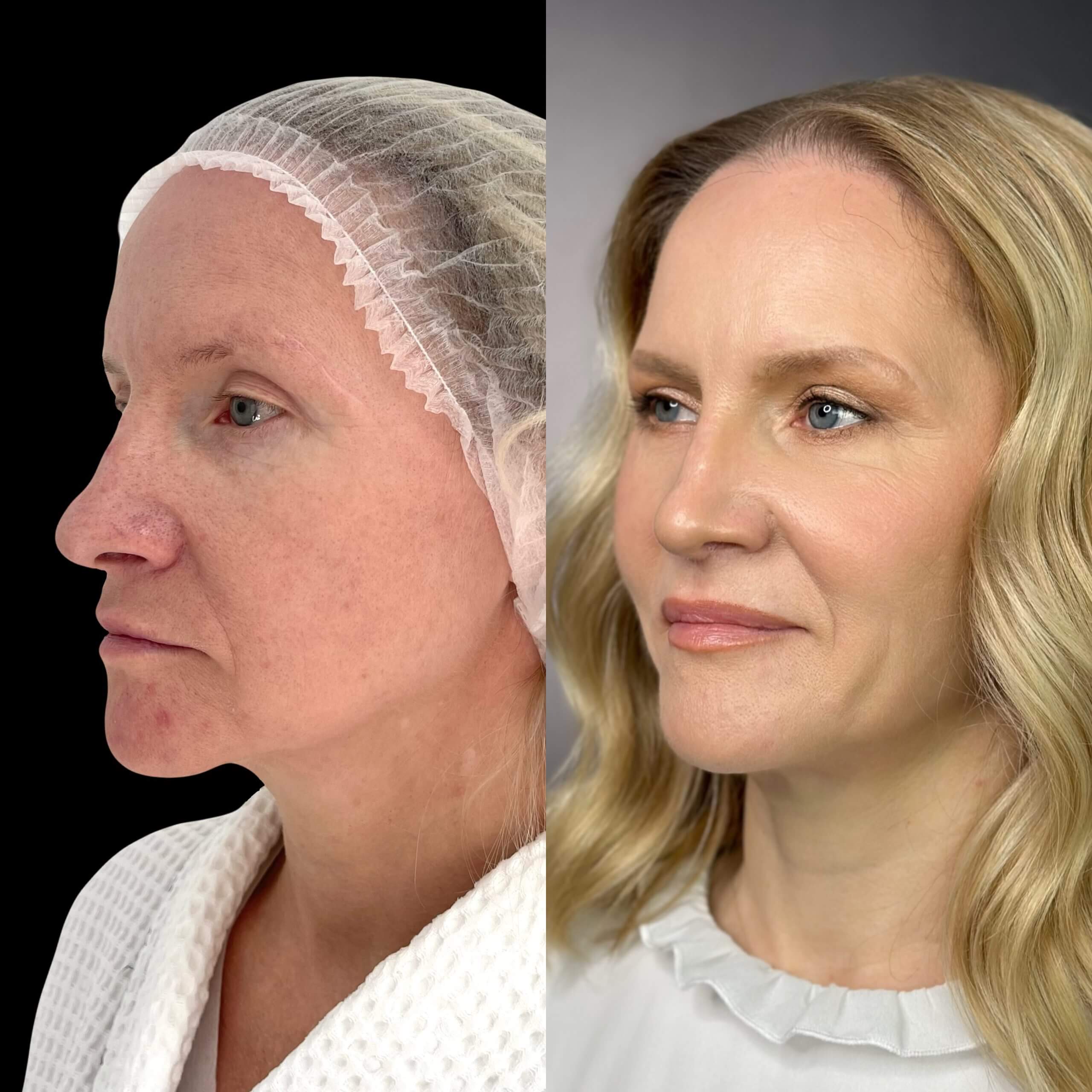 Ринопластика 01