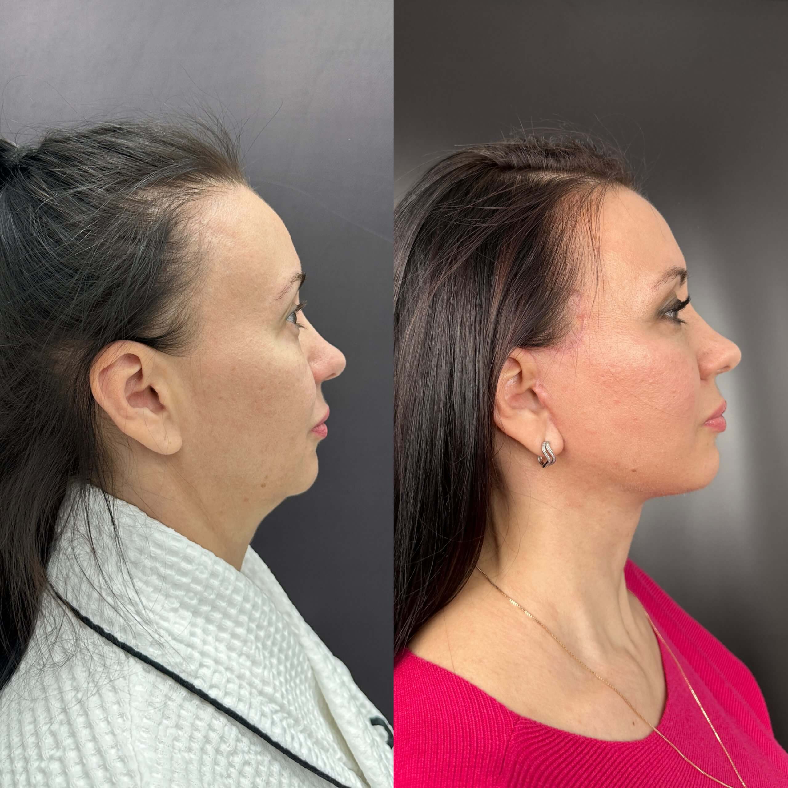 Липосакция подбородка и шеи 01