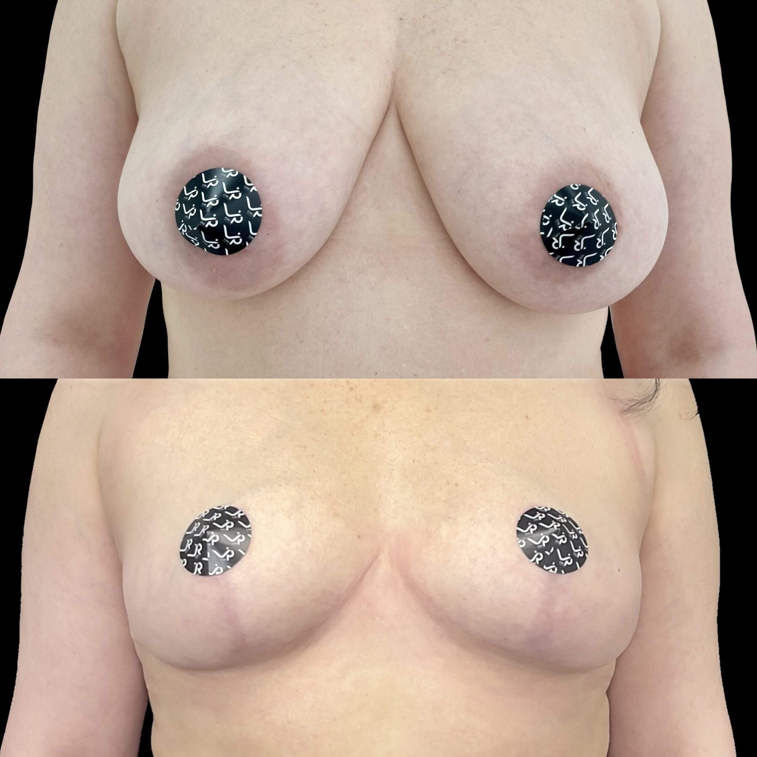 Подтяжка груди (мастопексия) 01